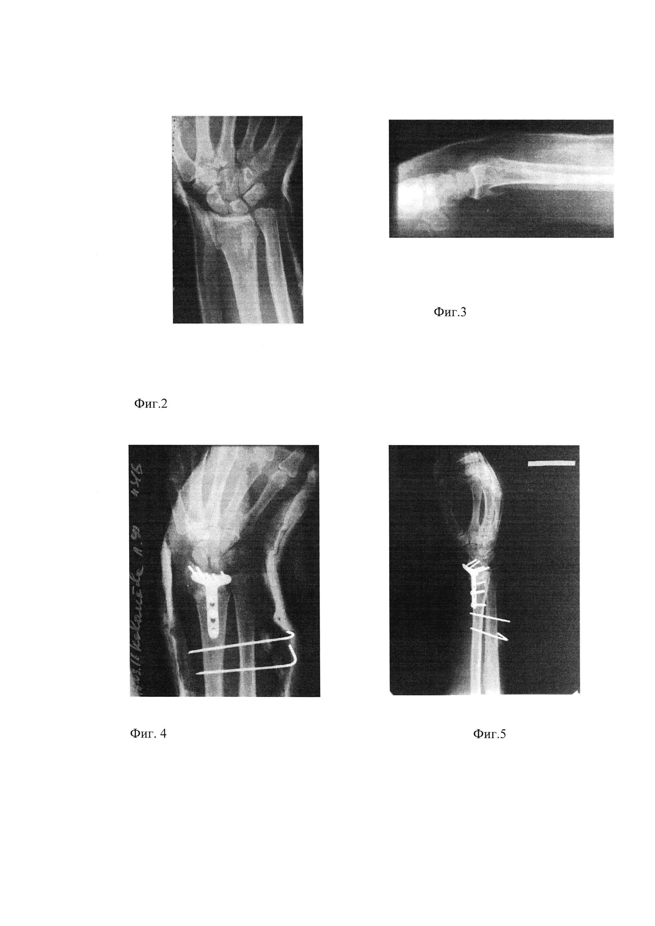 Способ хирургического доступа к дистальному отделу лучевой кости при переломах