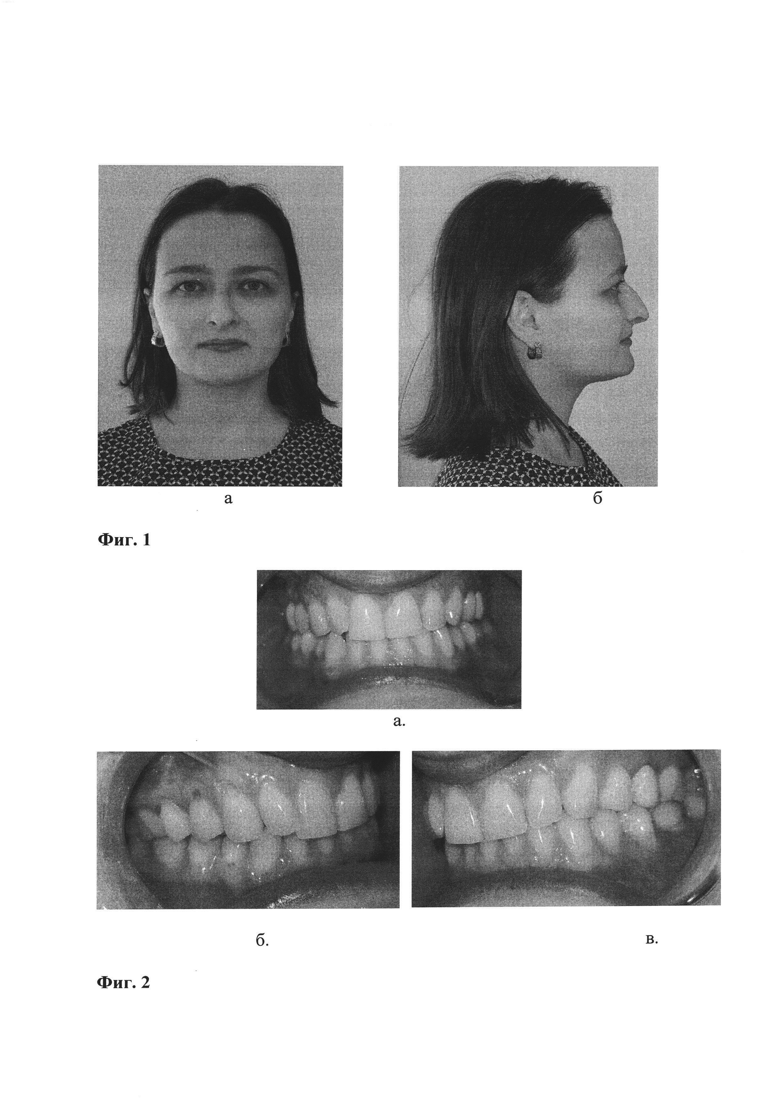 Способ дифференциальной диагностики нарушений движений нижней челюсти миогенной и артрогенной этиологии