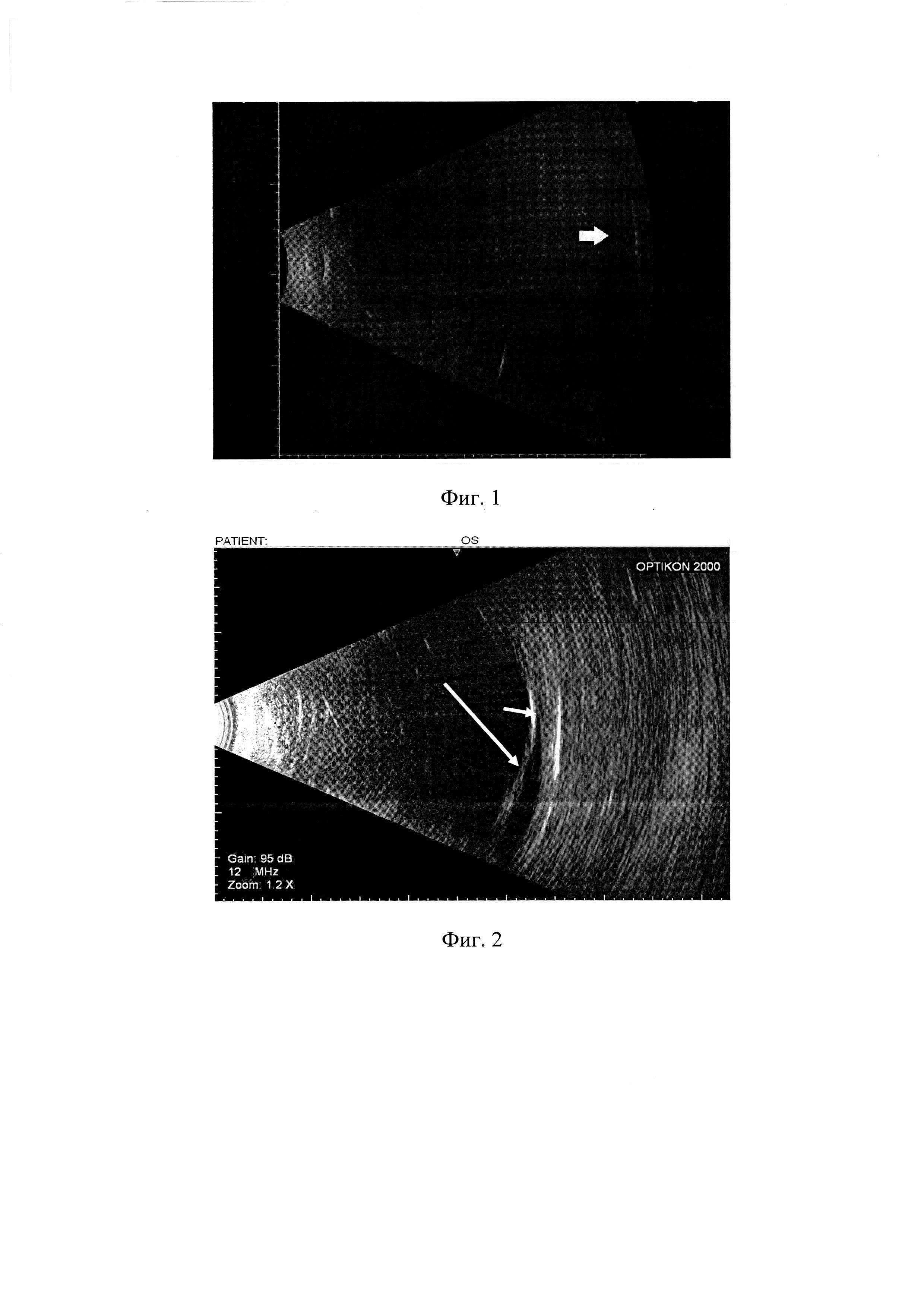 Способ оценки эффективности лечения отслойки сетчатки у пациентов с тампонадой силиконовым маслом и нарушением прозрачности оптических сред глаза