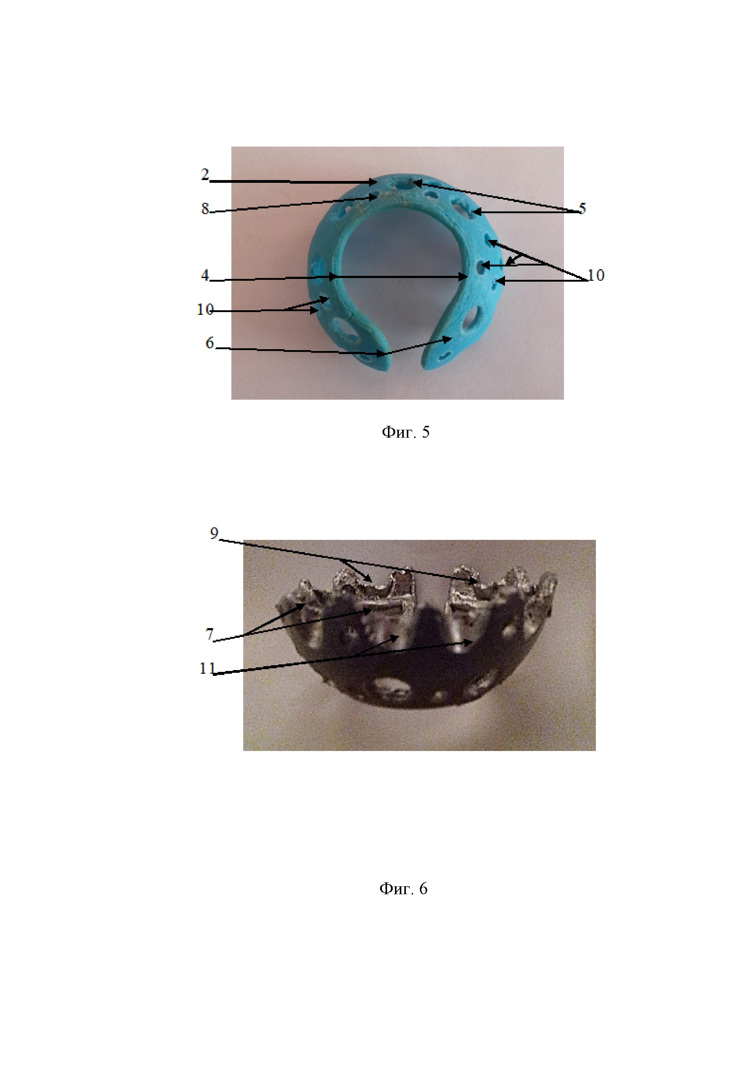 Универсальное репозиционно-фиксационное кольцо с динамической компрессией для оперативного лечения оскольчатых переломов вертлужной впадины.