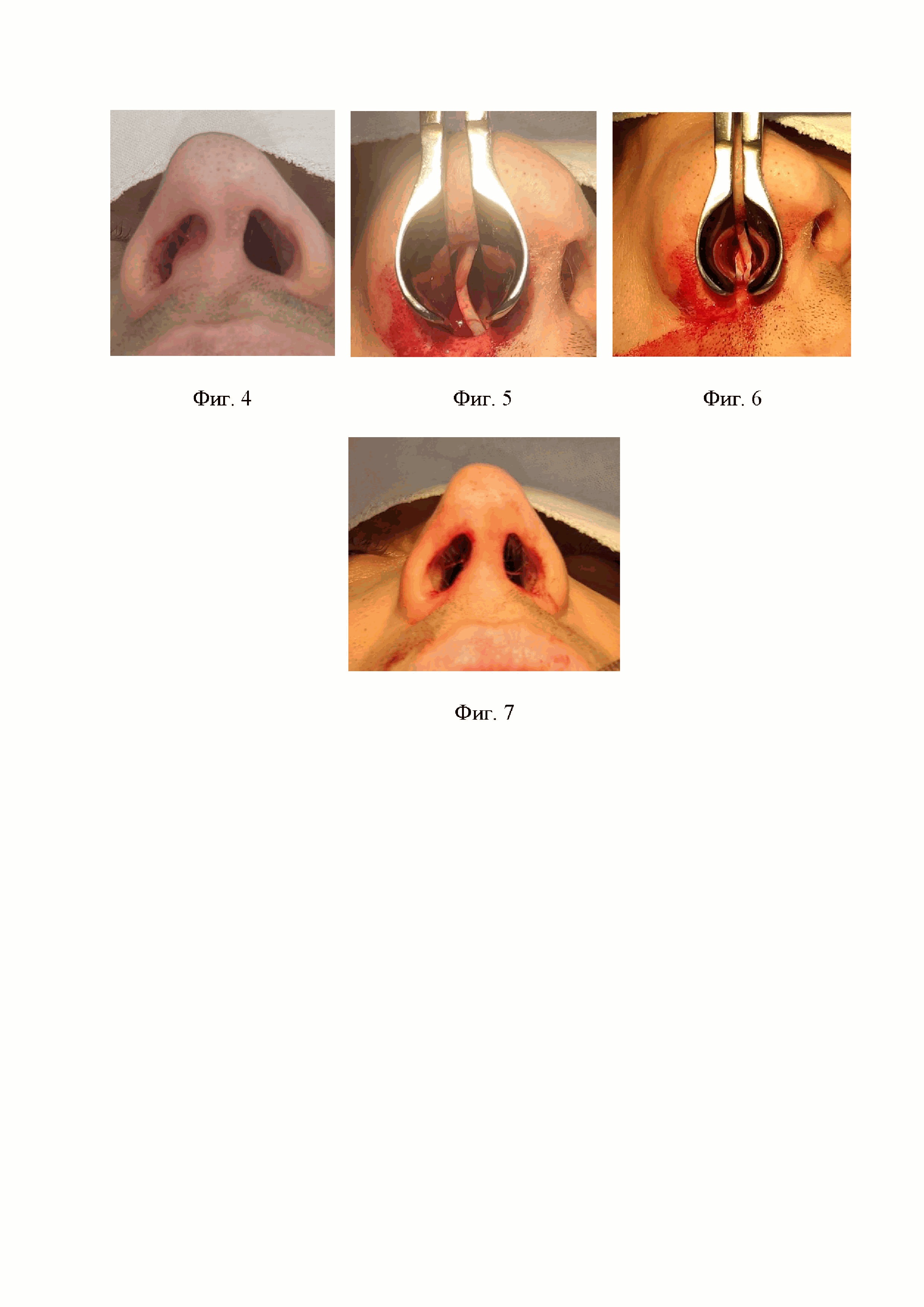 Способ хирургической коррекции С-образного искривления четырехугольного хряща носовой перегородки при септопластике