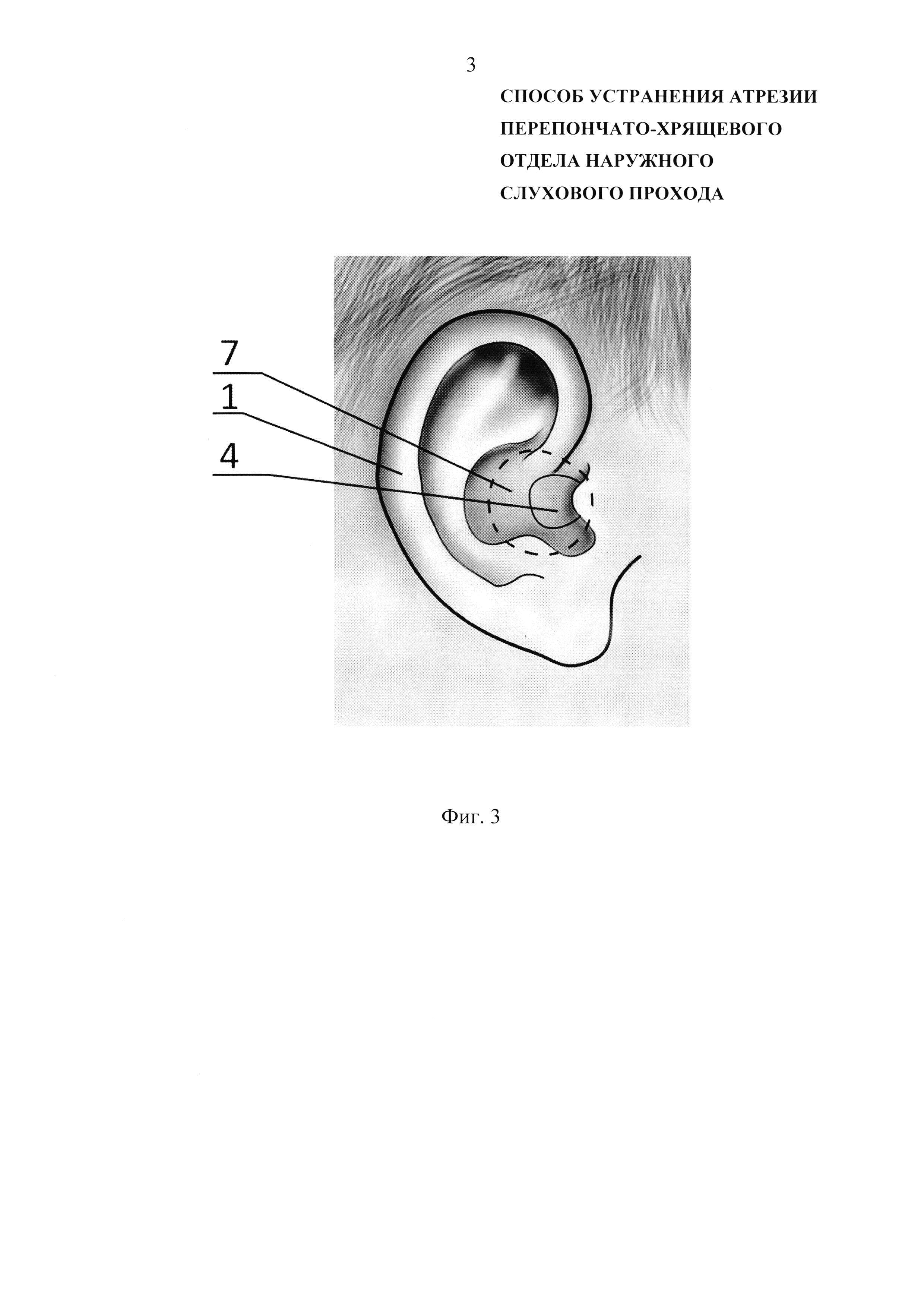 Способ устранения атрезии перепончато-хрящевого отдела наружного слухового прохода