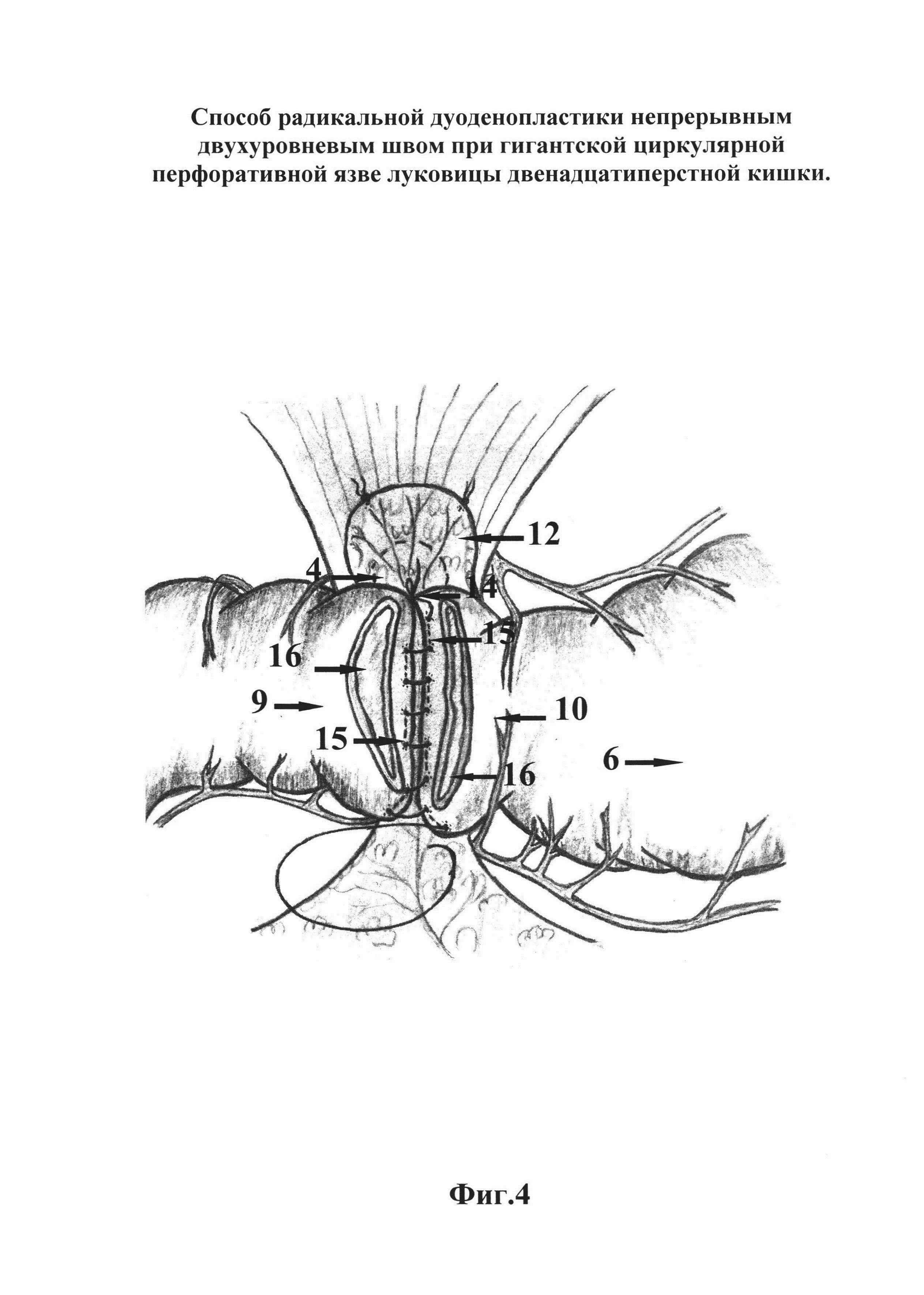 Способ радикальной дуоденопластики непрерывным двухуровневым швом при гигантской циркулярной перфоративной язве луковицы двенадцатиперстной кишки