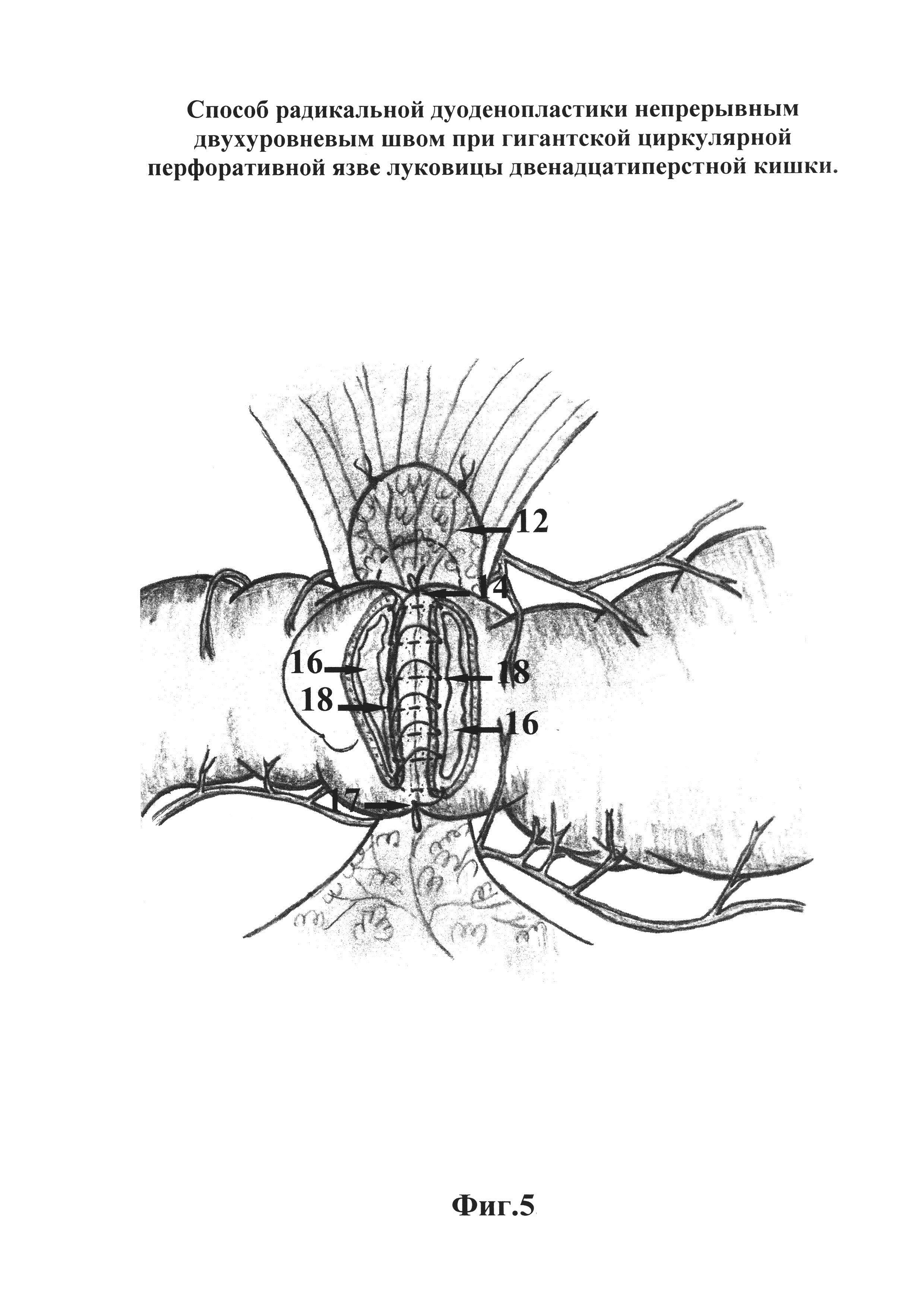 Способ радикальной дуоденопластики непрерывным двухуровневым швом при гигантской циркулярной перфоративной язве луковицы двенадцатиперстной кишки