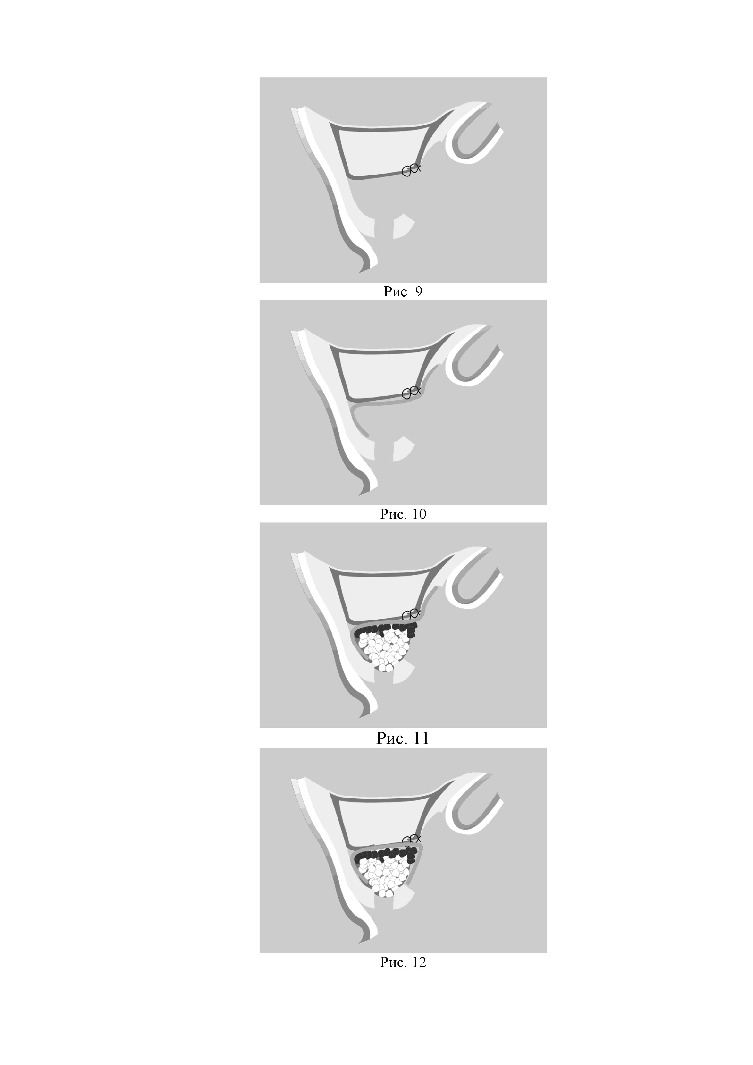 Способ пластики дистального отдела альвеолярного отростка верхней челюсти при хроническом полипозном верхнечелюстном синусите