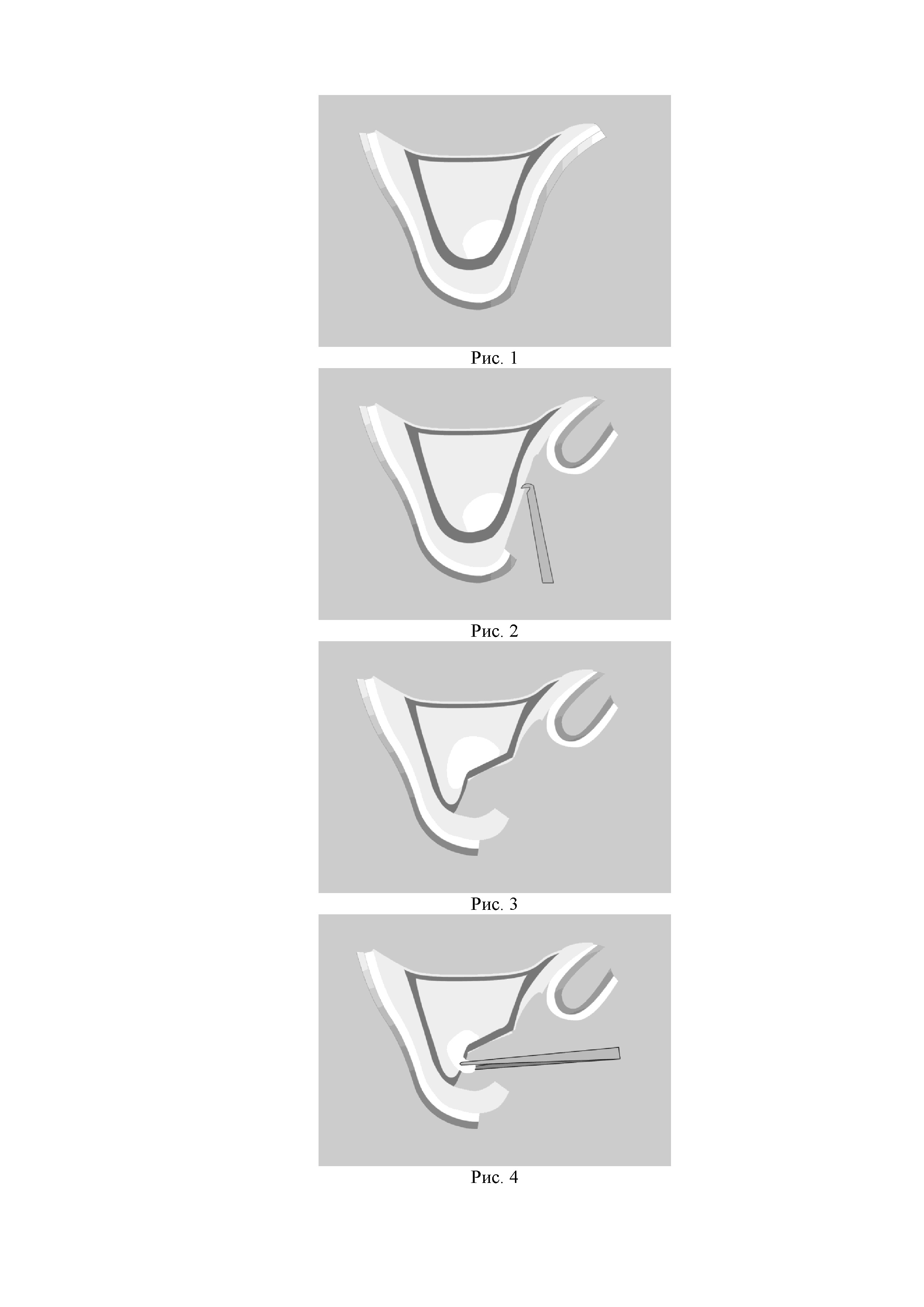 Способ пластики дистального отдела альвеолярного отростка верхней челюсти при хроническом полипозном верхнечелюстном синусите