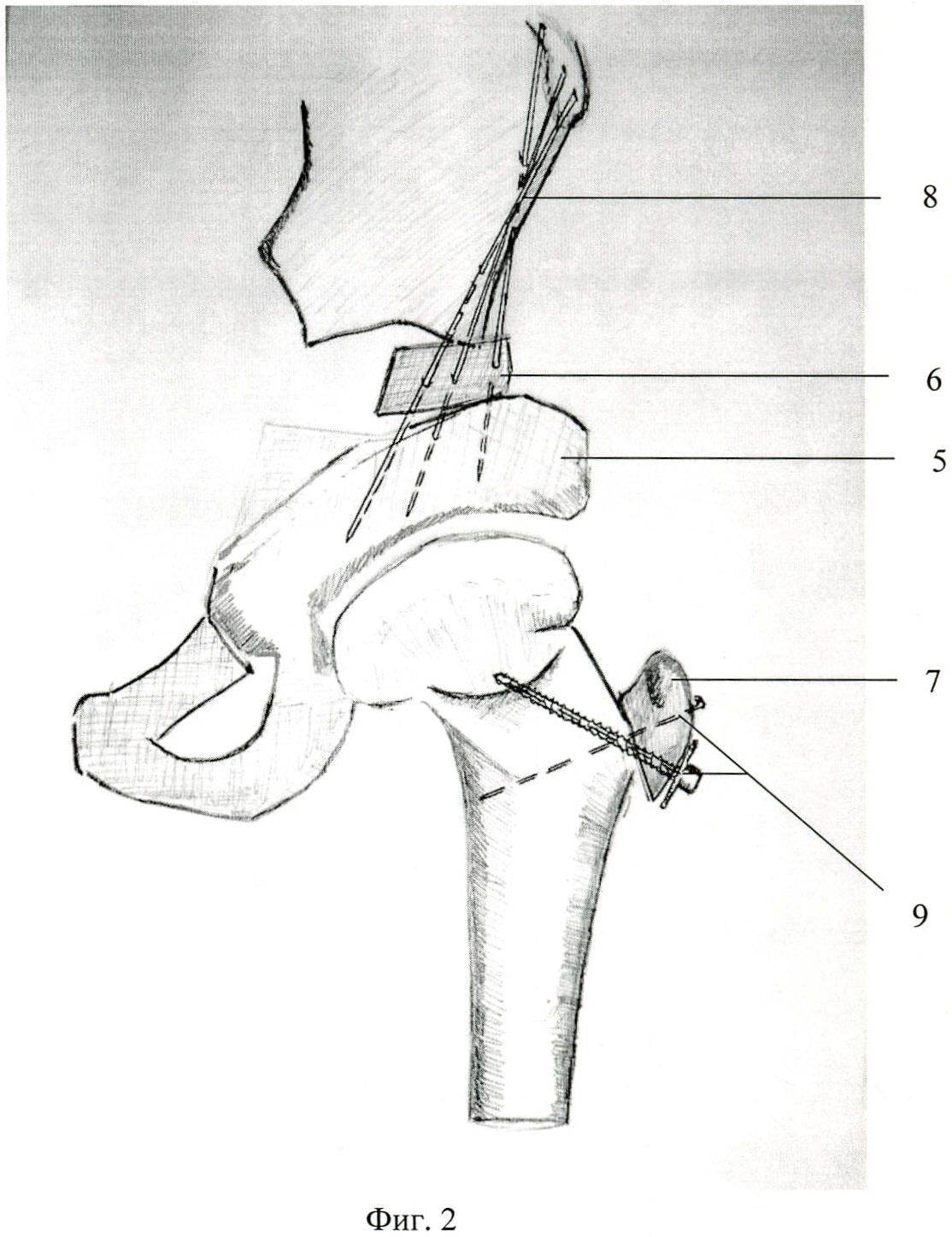 Остеотомия тазобедренного сустава
