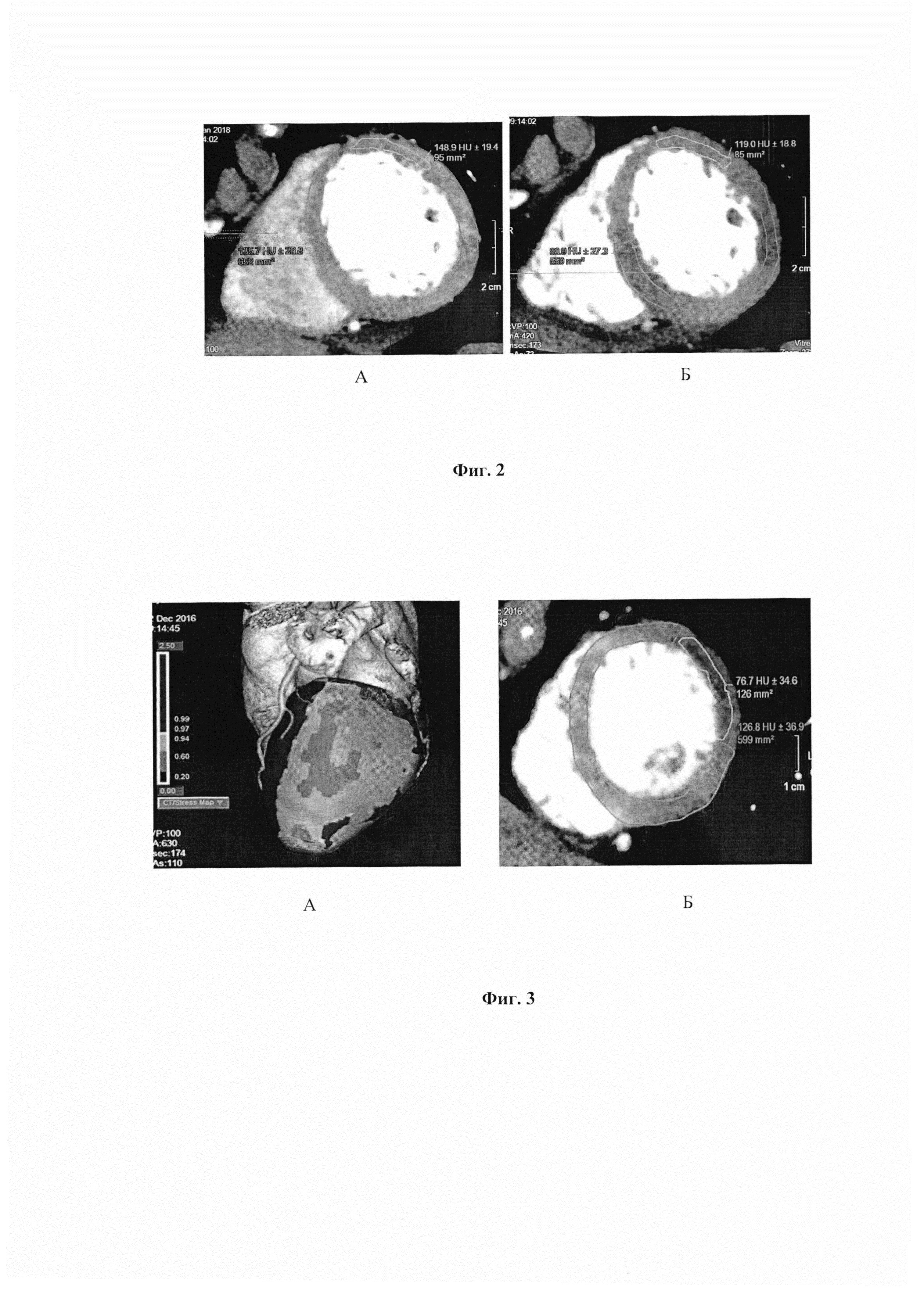Способ диагностики ишемии миокарда методом объёмной компьютерной томографии в сочетании с фармакологической пробой аденозинтрифосфатом