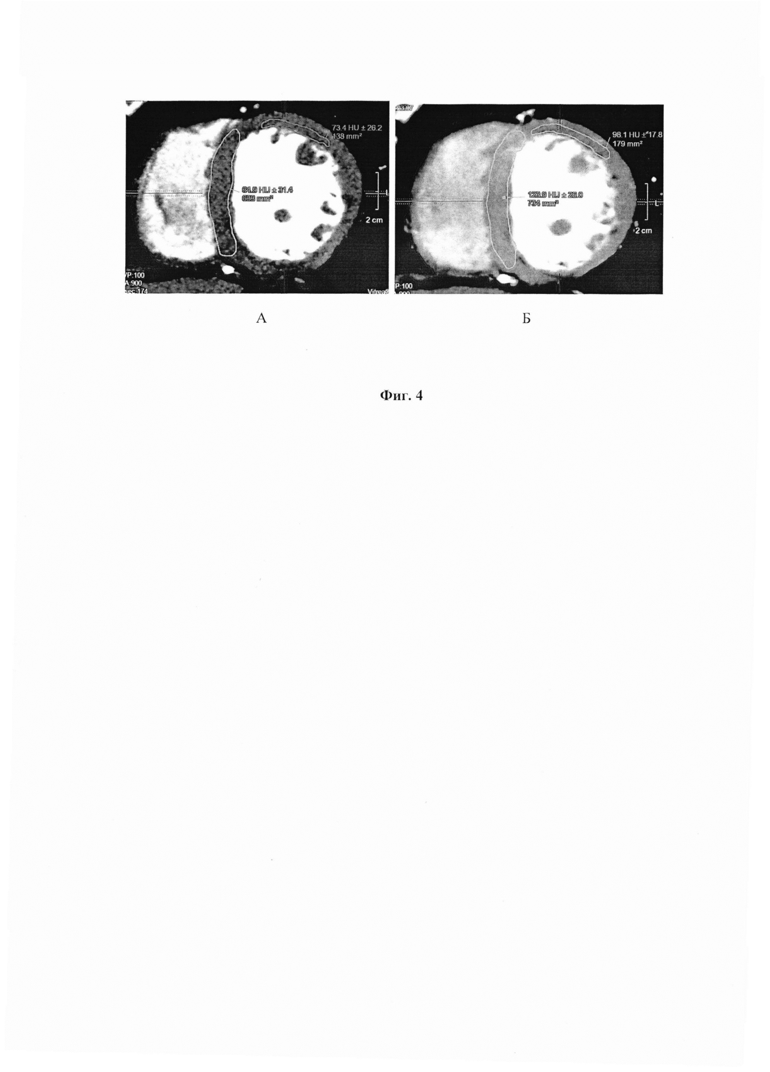 Способ диагностики ишемии миокарда методом объёмной компьютерной томографии в сочетании с фармакологической пробой аденозинтрифосфатом