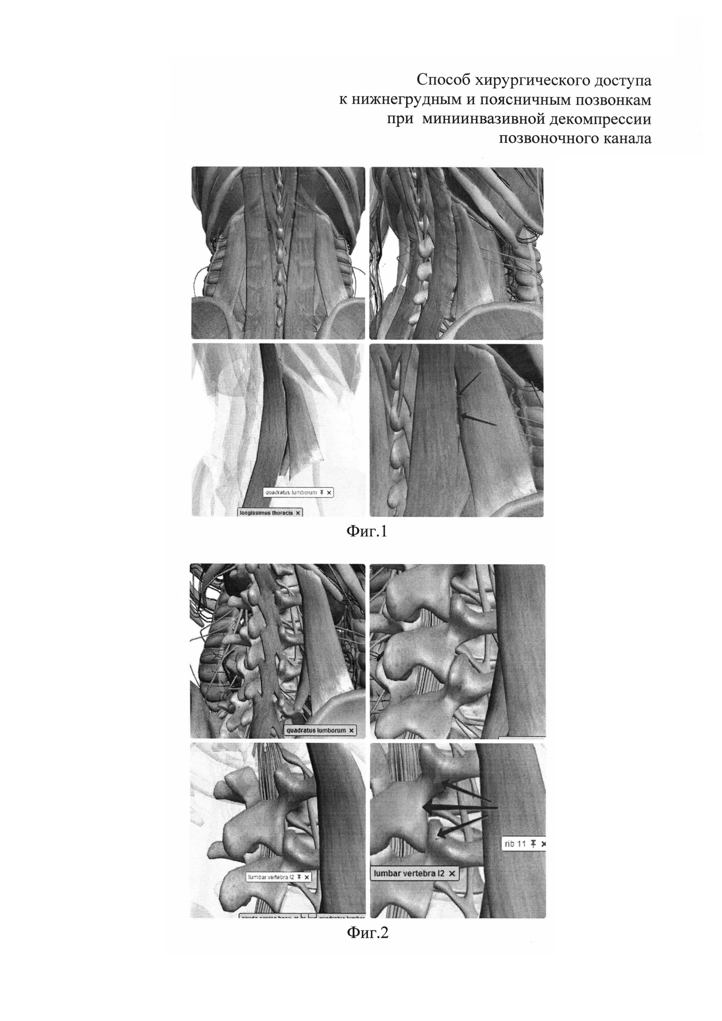 СПОСОБ ХИРУРГИЧЕСКОГО ДОСТУПА К НИЖНЕГРУДНЫМ И ПОЯСНИЧНЫМ ПОЗВОНКАМ ПРИ МИНИИНВАЗИВНОЙ ДЕКОМПРЕССИИ ПОЗВОНОЧНОГО КАНАЛА