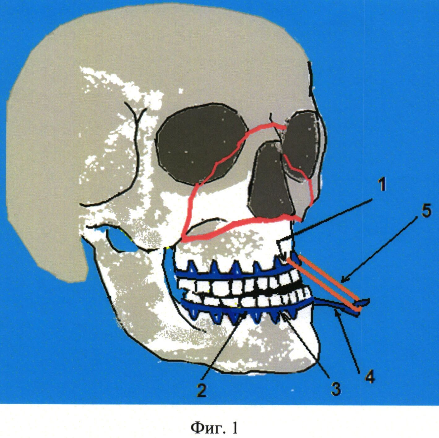 Переломы скелета. Переломы средней зоны лица. Перелом костей лицевого скелета. Переломы костей средней зоны лица.