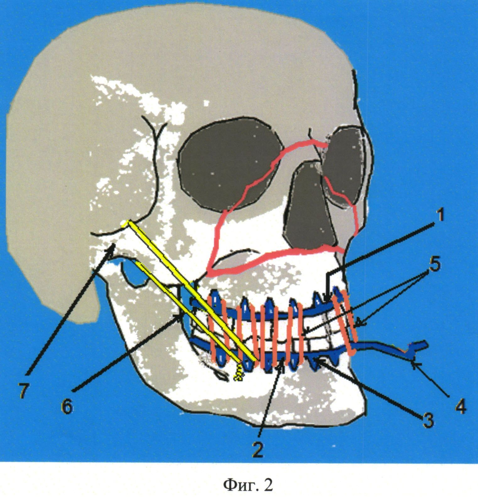 Перелом лицевого черепа. Перелом лицевого скелета. Переломы средней зоны лица. Переломы костей средней зоны лица.