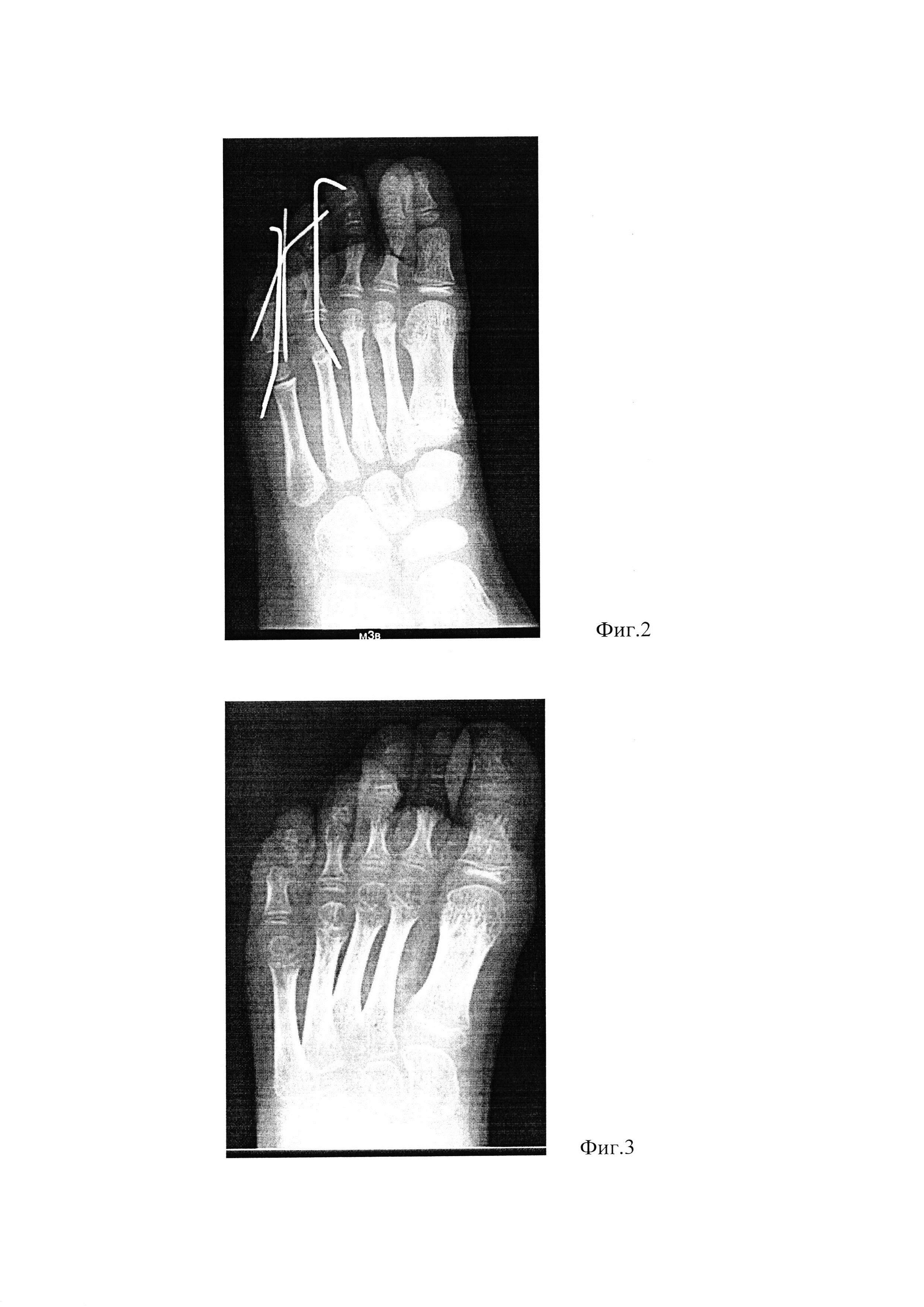 Способ лечения полифалангии пальцев стопы при наличии недоразвитых фаланг