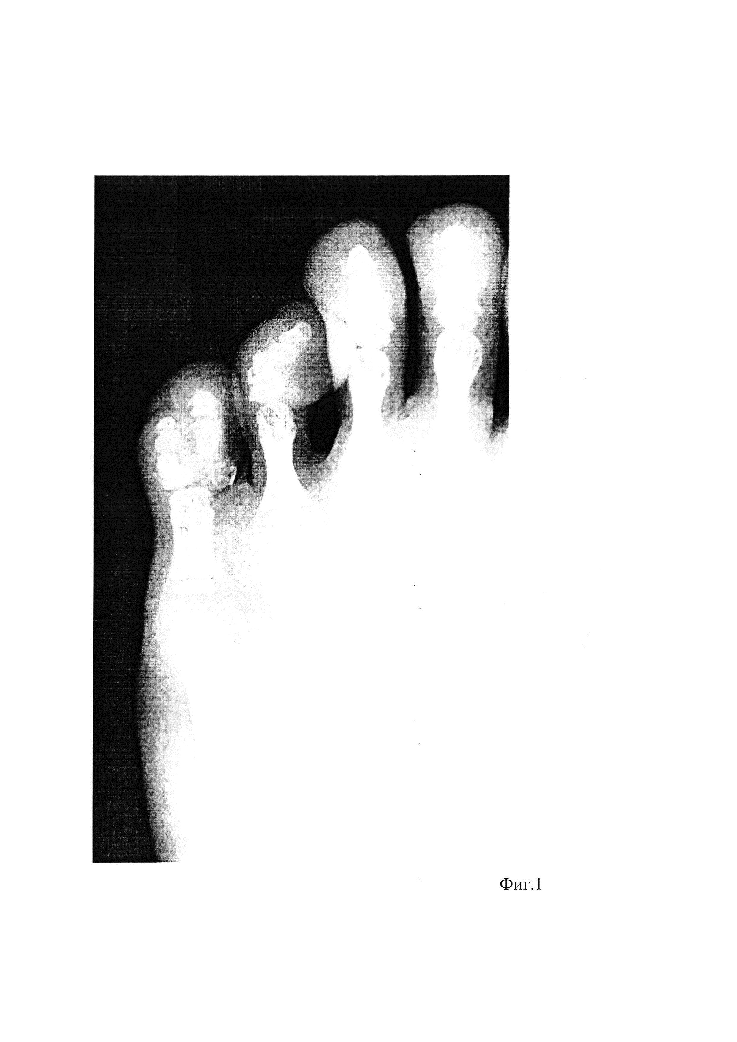 Способ лечения полифалангии пальцев стопы при наличии недоразвитых фаланг