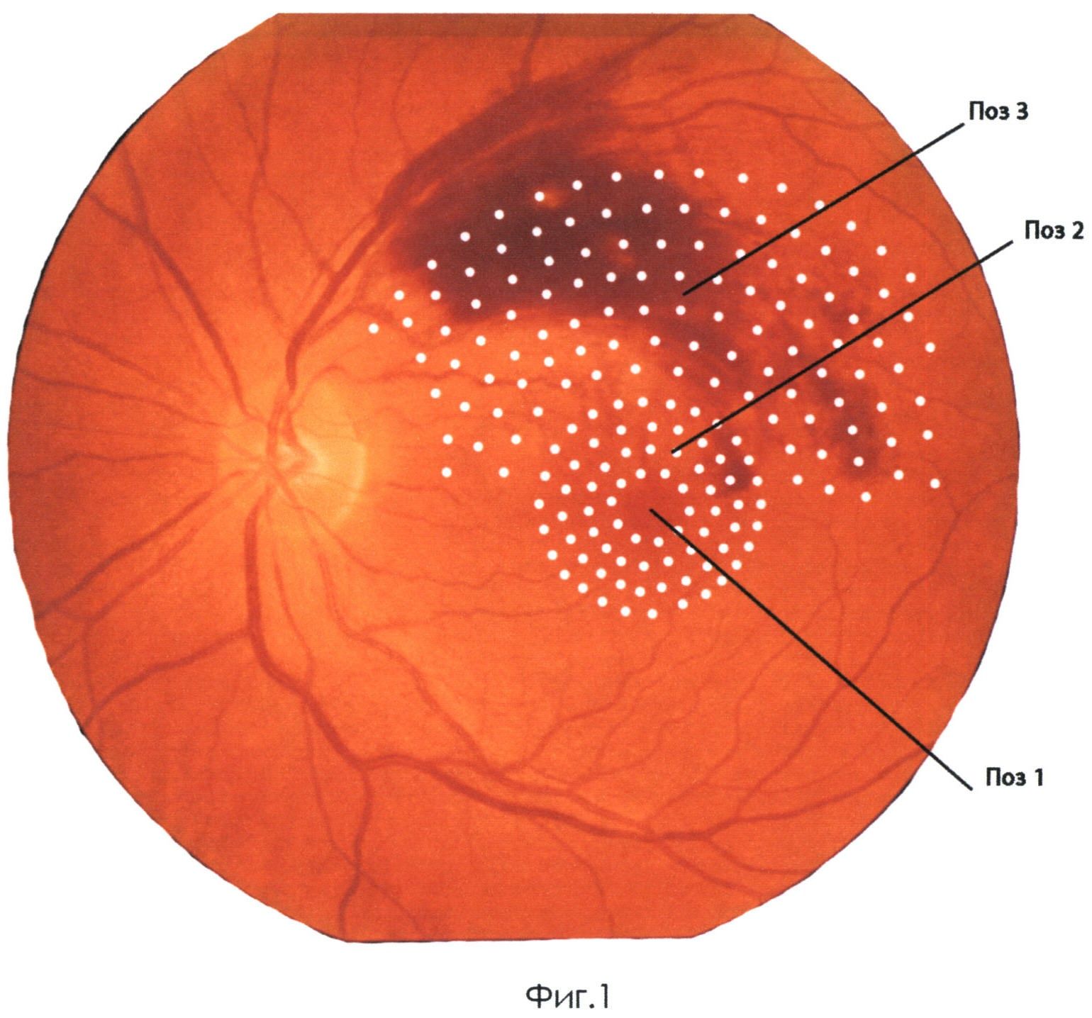 Глаз после лазерной коагуляции сетчатки. Периферическая лазеркоагуляция сетчатки. Панретинальная лазеркоагуляция сетчатки. Лазеркоагуляция сетчатки при диабетической ретинопатии. Барьерная лазеркоагуляция сетчатки.