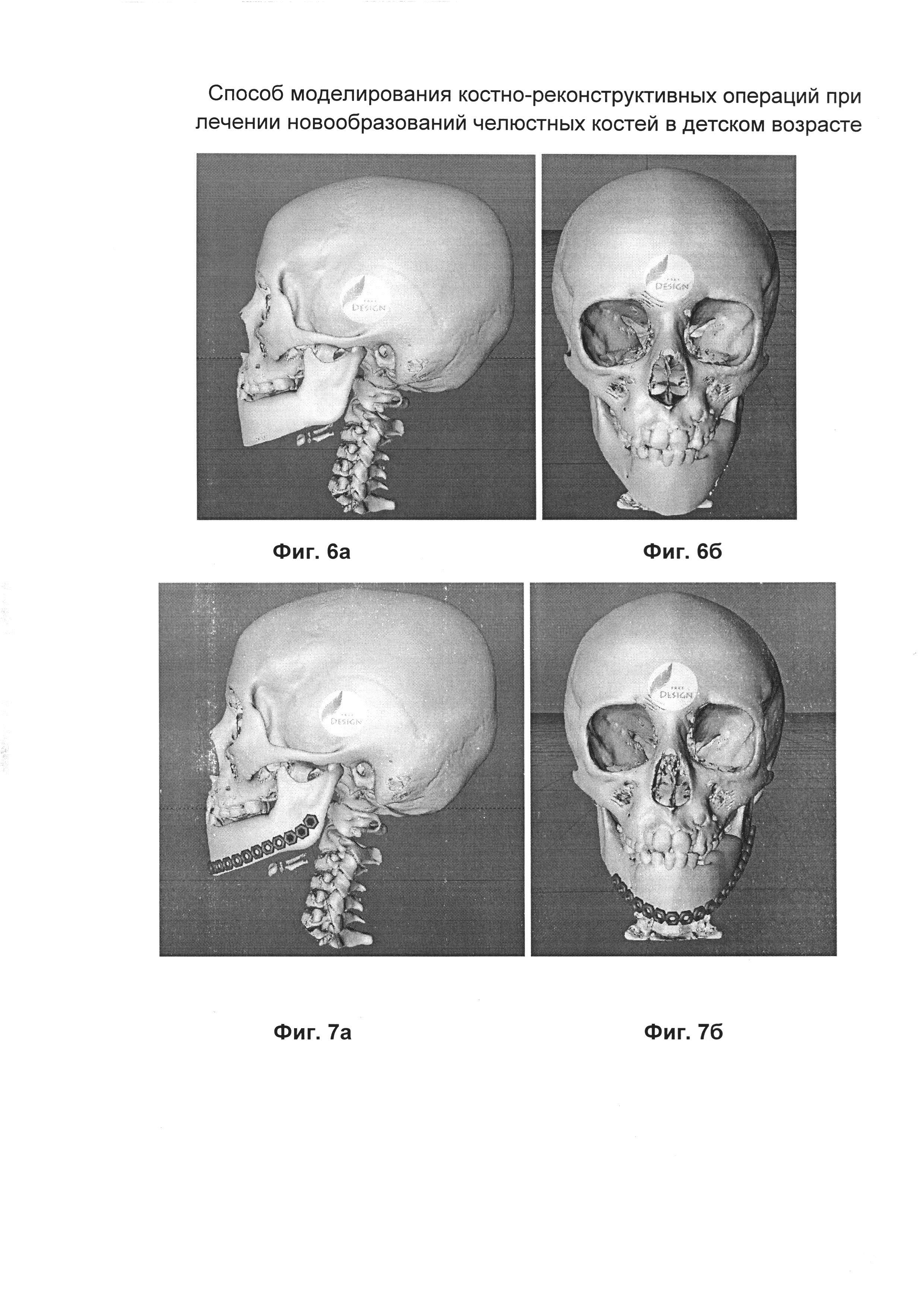 Способ моделирования костно-реконструктивных операций при лечении новообразований челюстных костей в детском возрасте