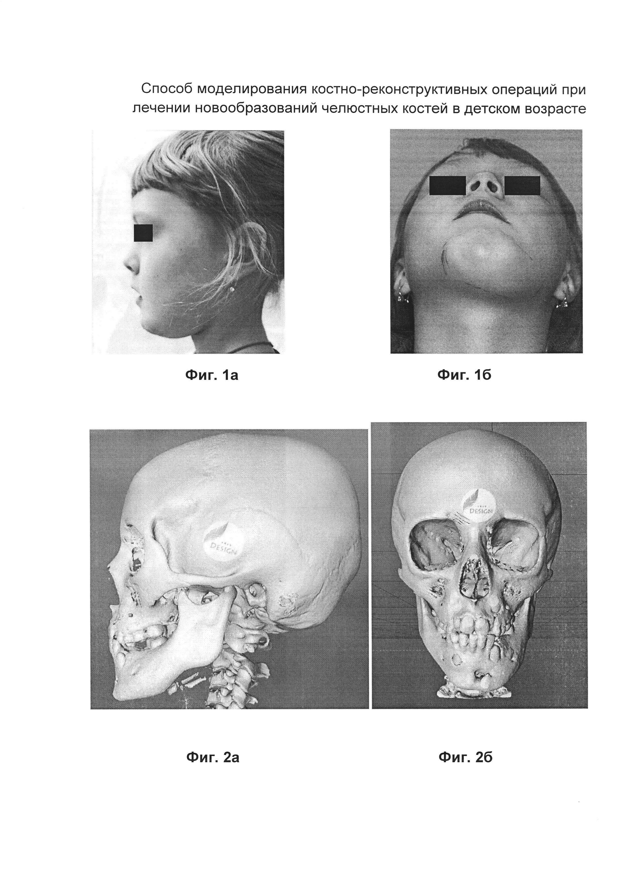 Способ моделирования костно-реконструктивных операций при лечении новообразований челюстных костей в детском возрасте