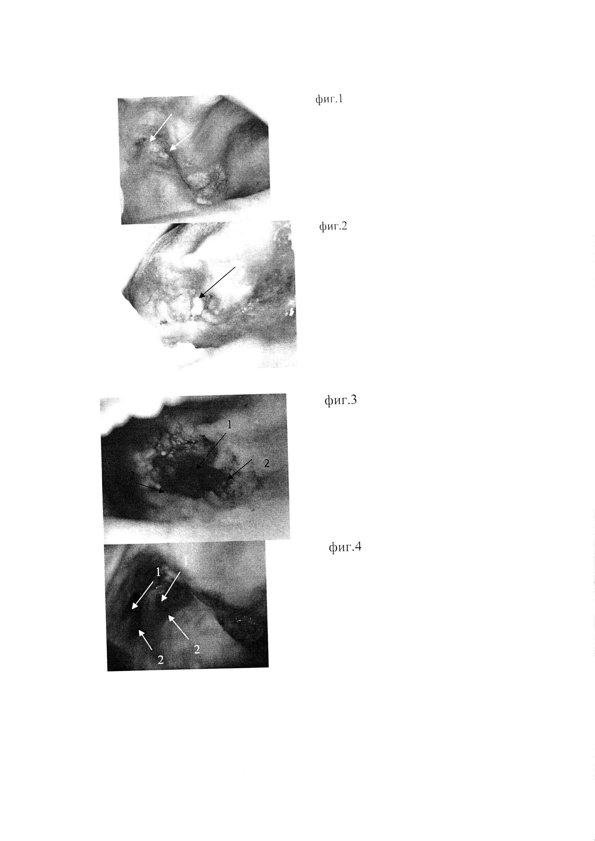 Способ визуализации элементов поражения слизистой оболочки рта с помощью аутофлуоресцентной стоматоскопии с окрашиванием для проведения биопсии