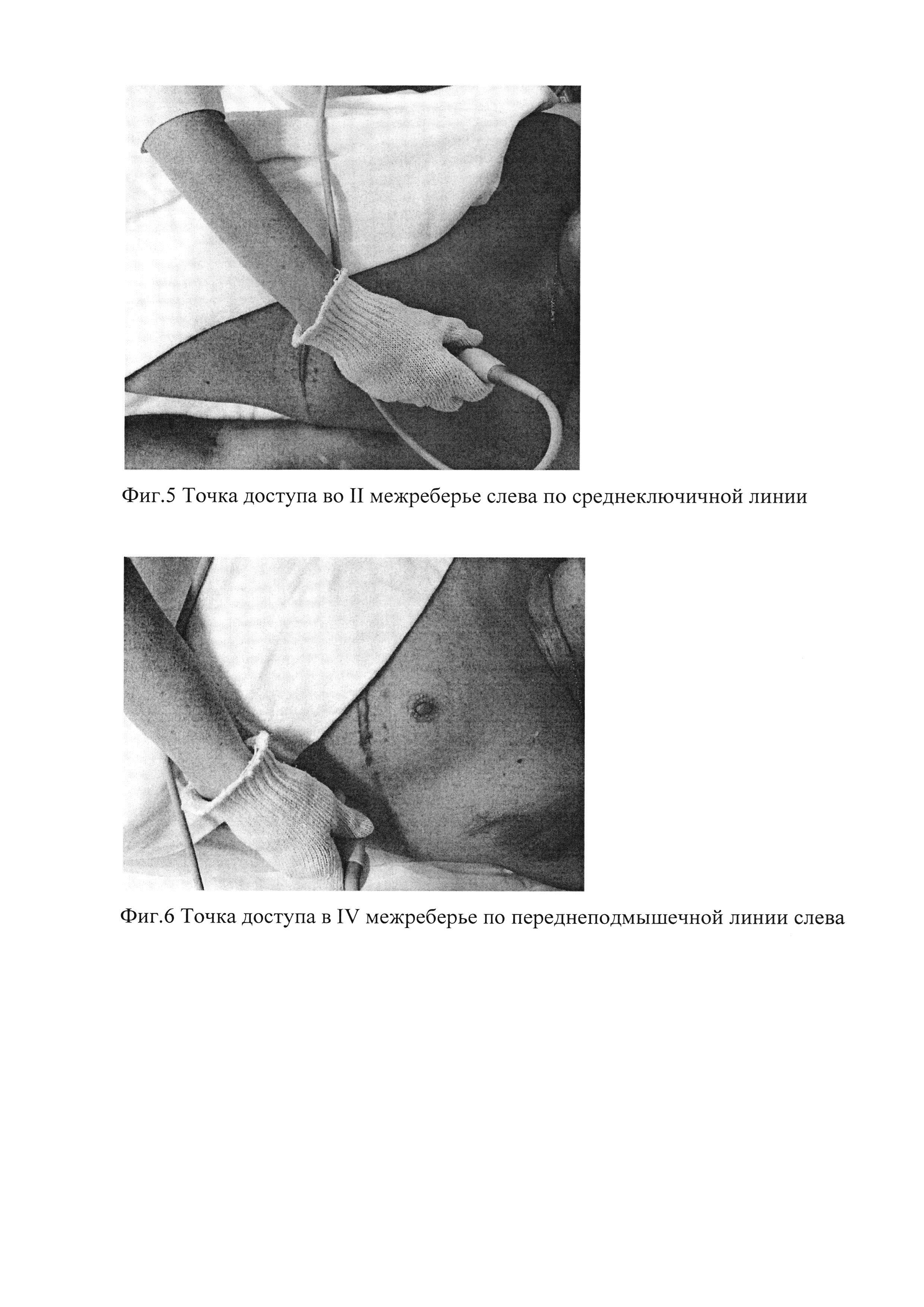 Способ эхокардиографии у пациентов после операции пневмонэктомии в отдаленном периоде