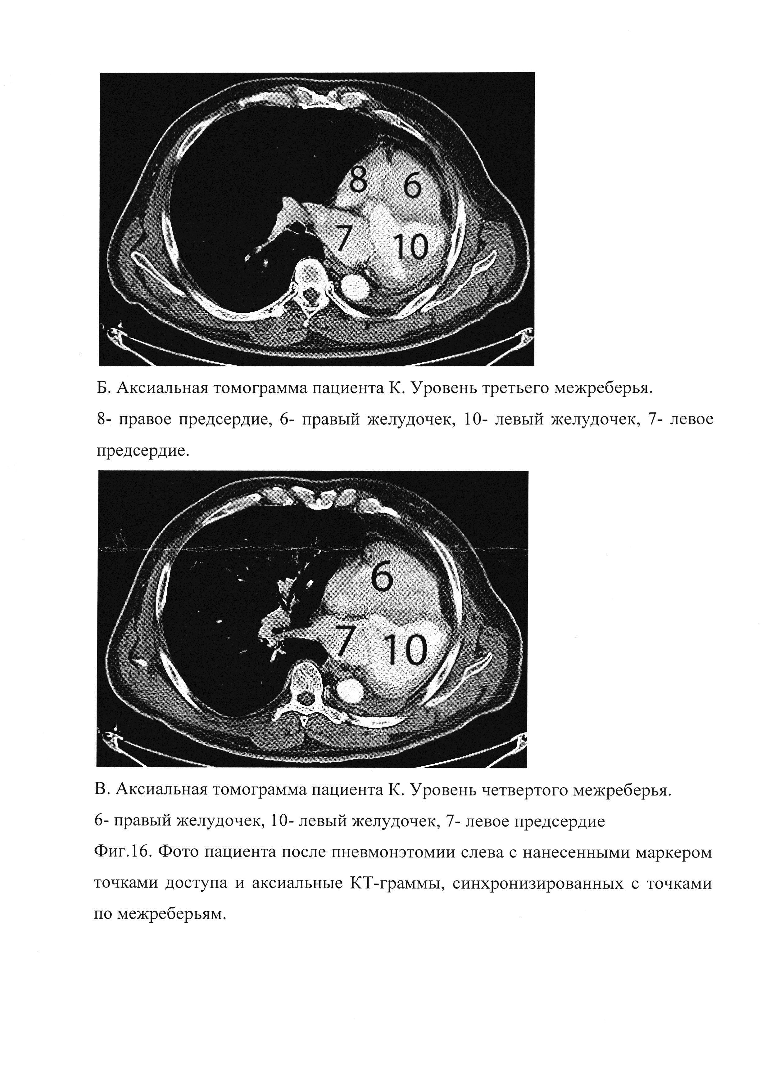 Способ эхокардиографии у пациентов после операции пневмонэктомии в отдаленном периоде