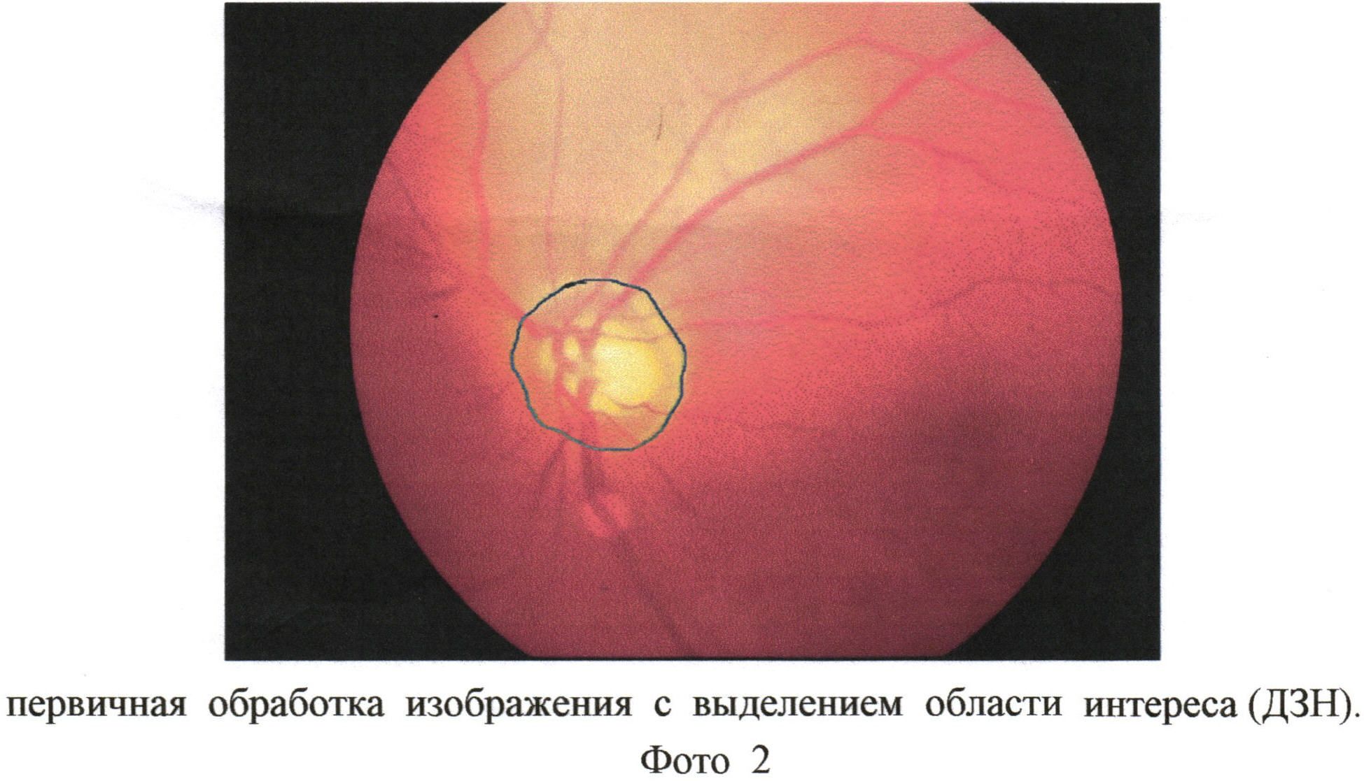 Расширение пространства зрительного нерва. Экскавация зрительного нерва. Оптическая когерентная томография диска зрительного нерва. Окт диска зрительного нерва. Диск зрительного нерва анатомия.