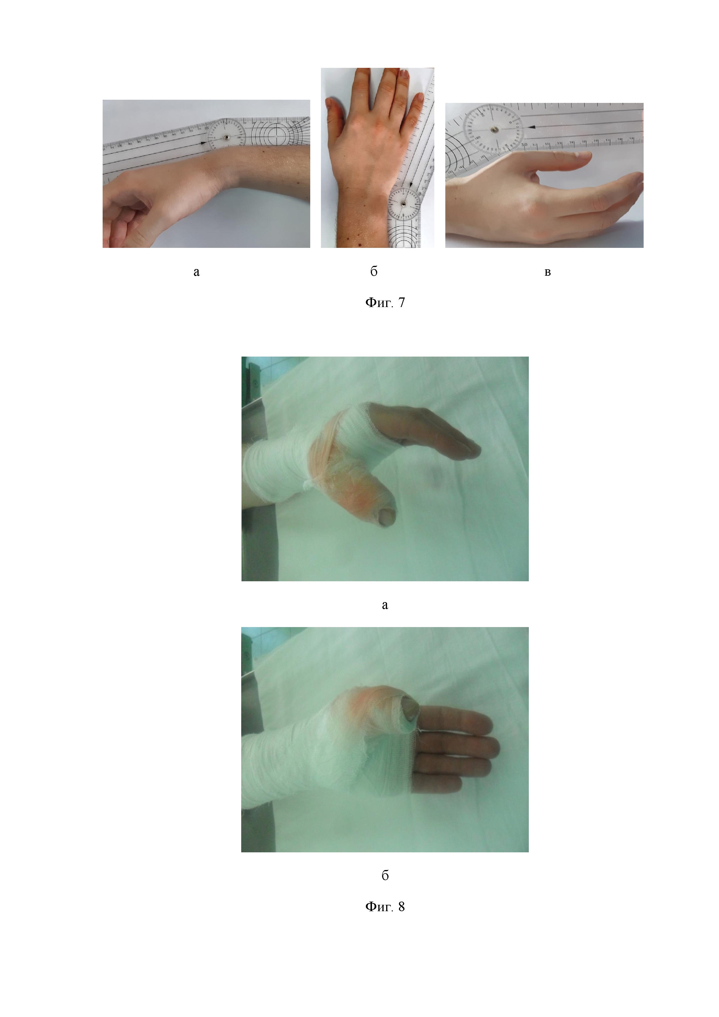 Способ восстановления сухожилий разгибателей пальцев кисти на уровне дистального межфалангового сустава (варианты)