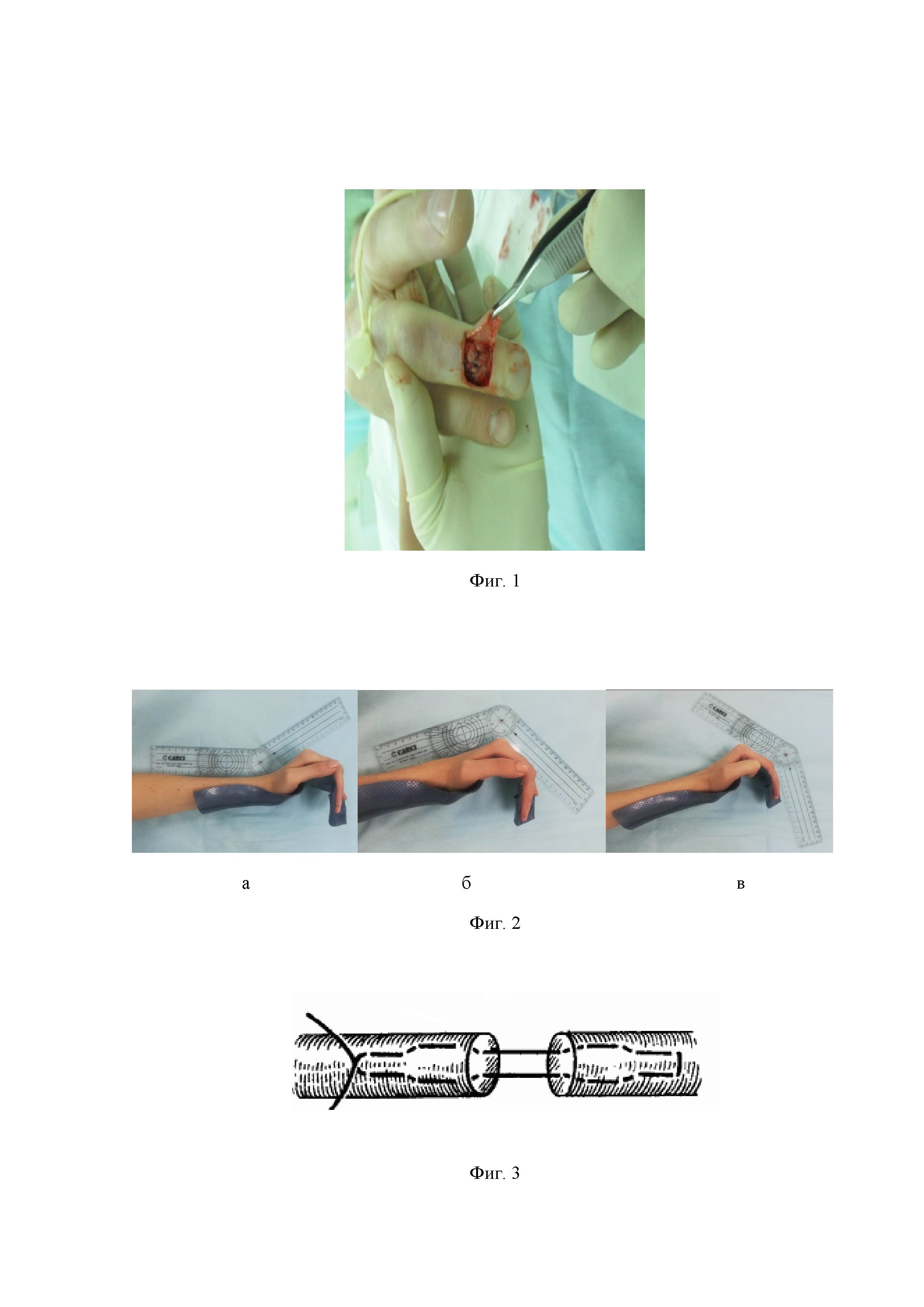 Способ восстановления сухожилий разгибателей пальцев кисти на уровне дистального межфалангового сустава (варианты)