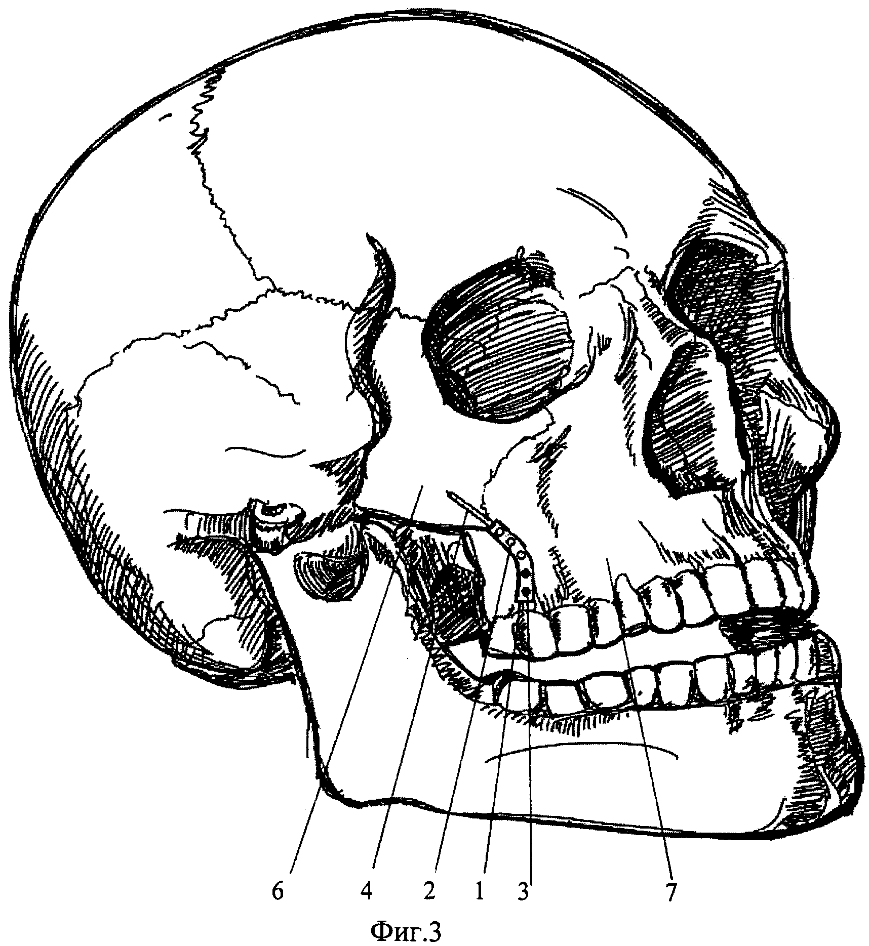 Анатомия скуловой кости. Скуловая кость черепа. Оскольчатый перелом скуловой кости. Скуловая кость черепа анатомия. Анатомия скуловой кости и дуги.