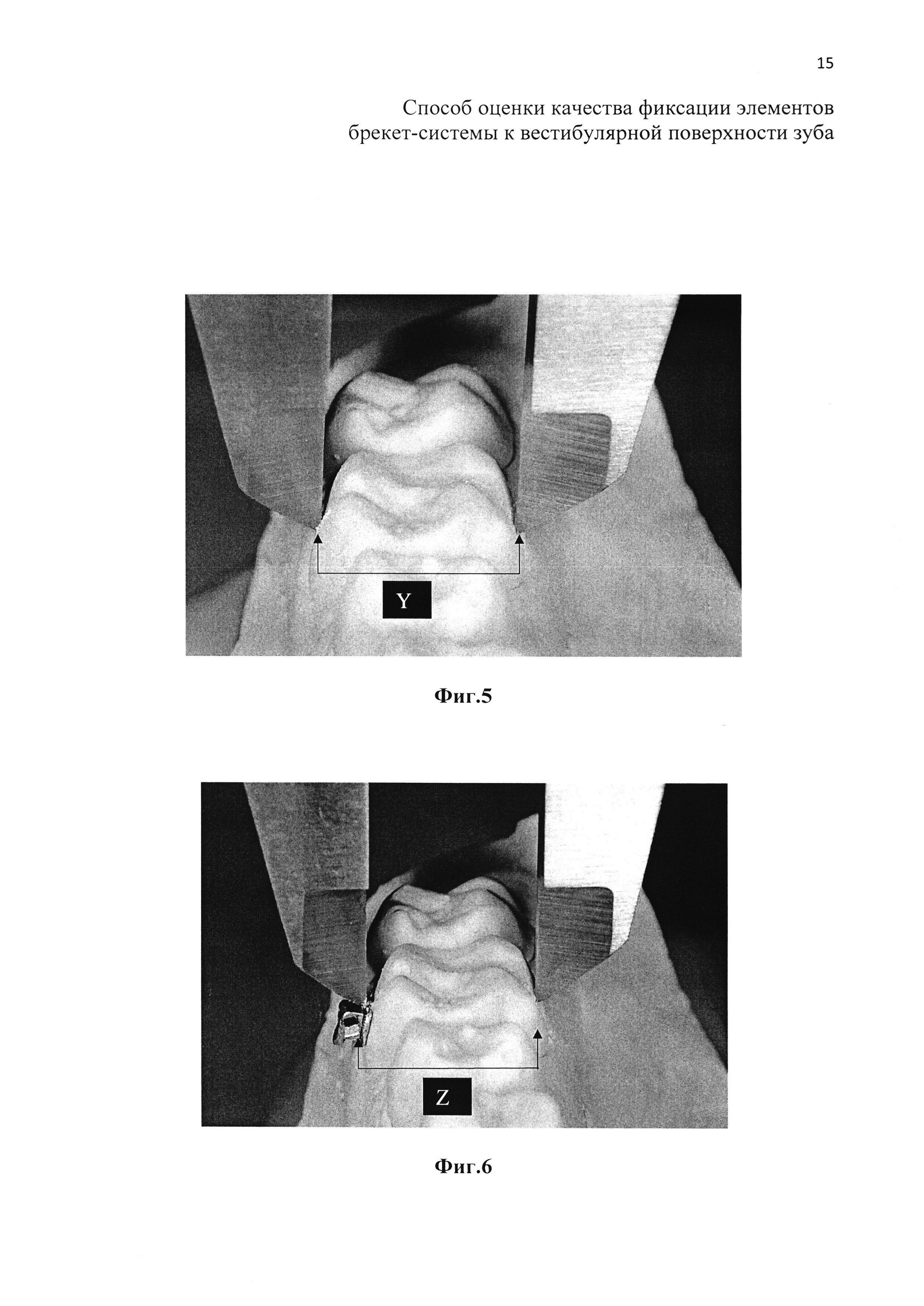 Способ оценки качества фиксации элементов брекет-системы к вестибулярной поверхности зуба