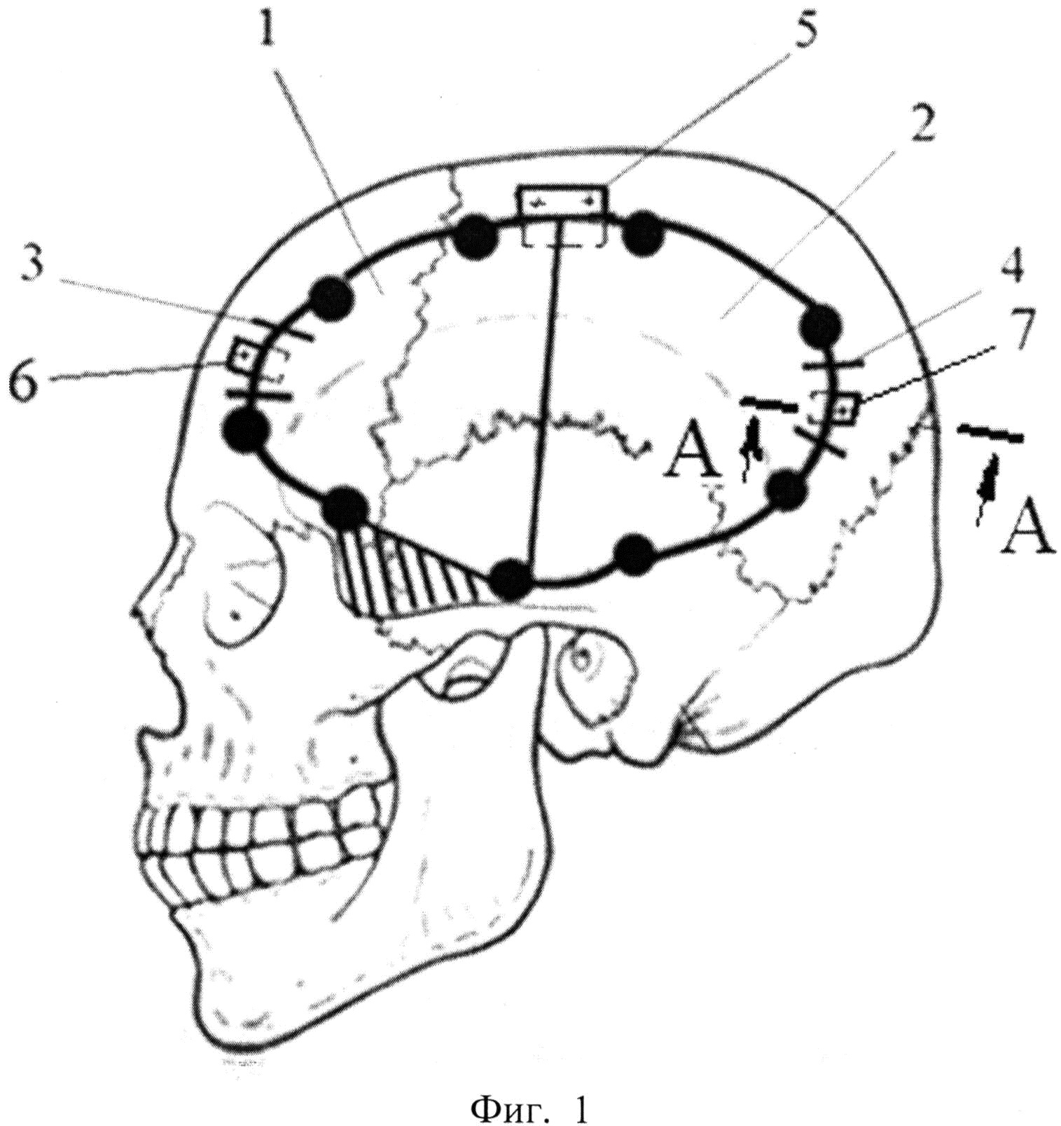 Способ створчатой трепанации черепа