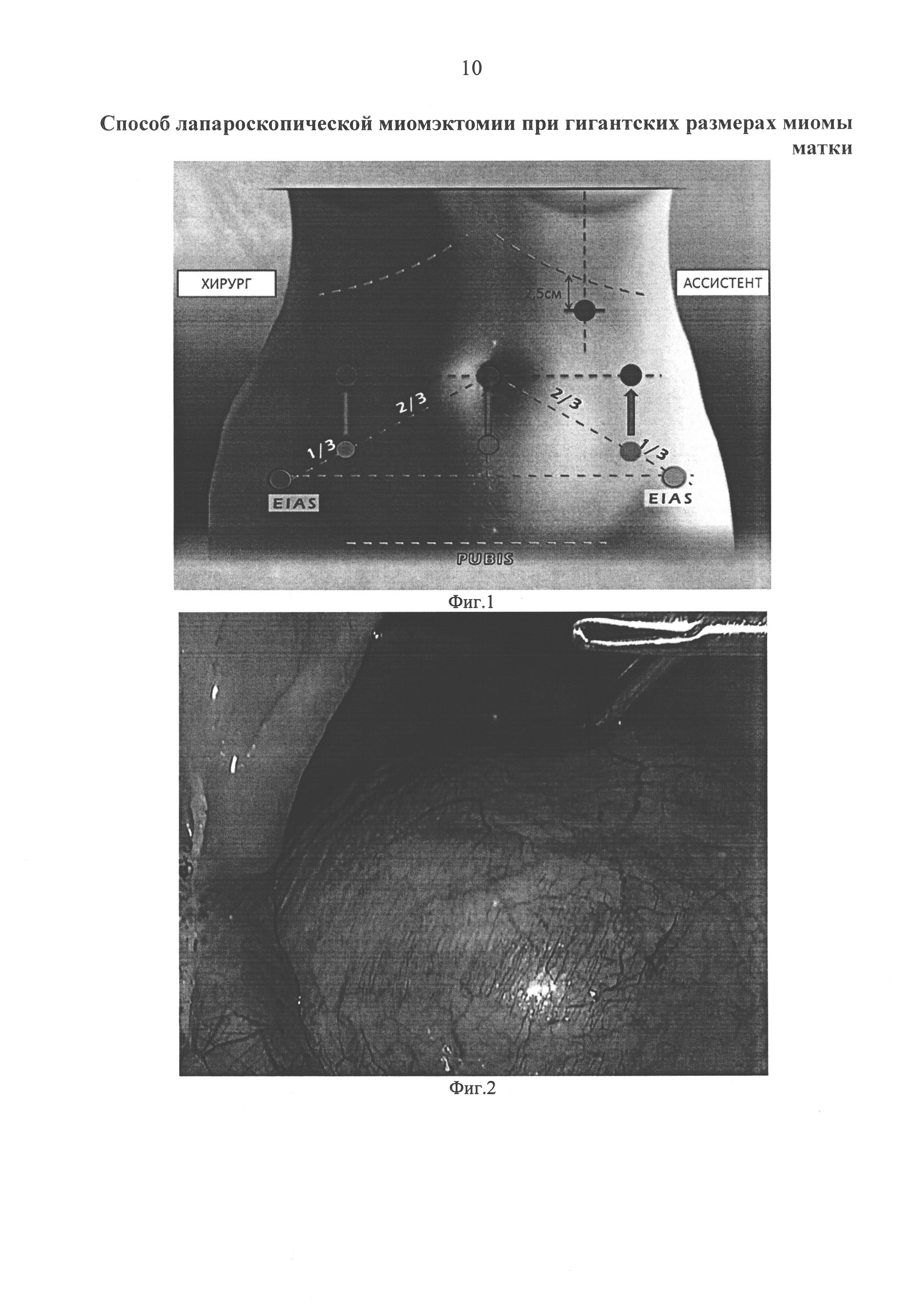 Способ лапароскопической миомэктомии при гигантских размерах миомы матки