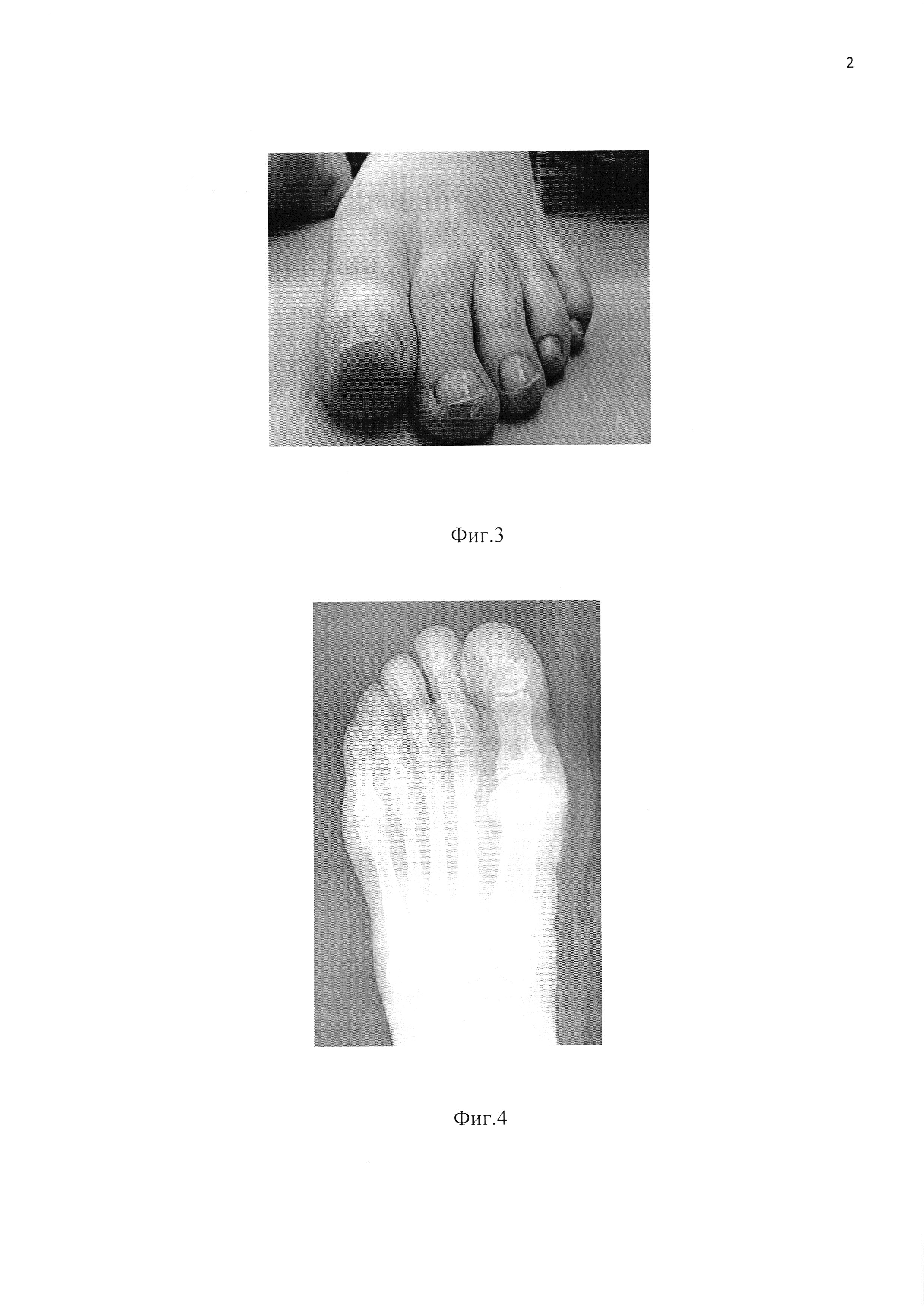 Способ коррекции отведенной деформации II-IV пальцев стопы