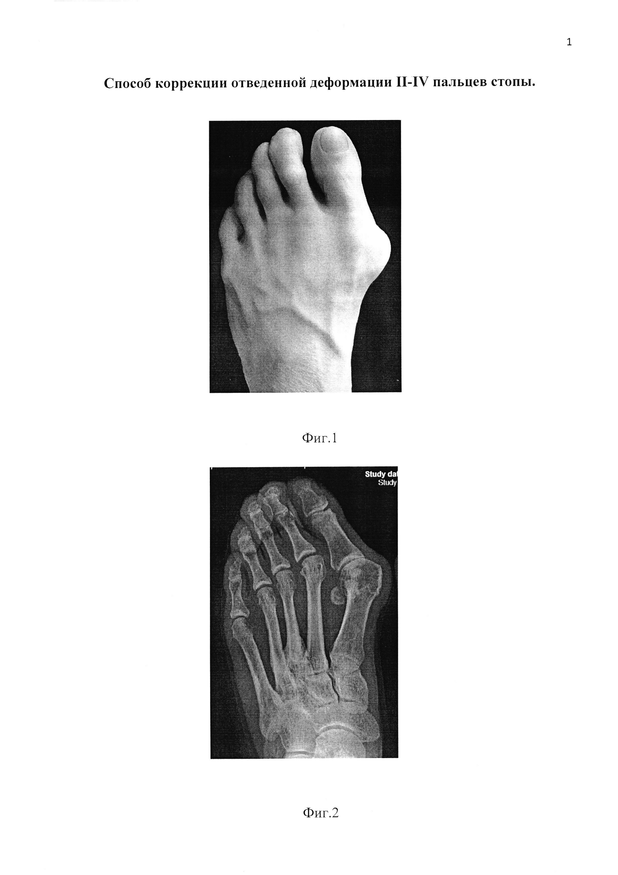 Способ коррекции отведенной деформации II-IV пальцев стопы