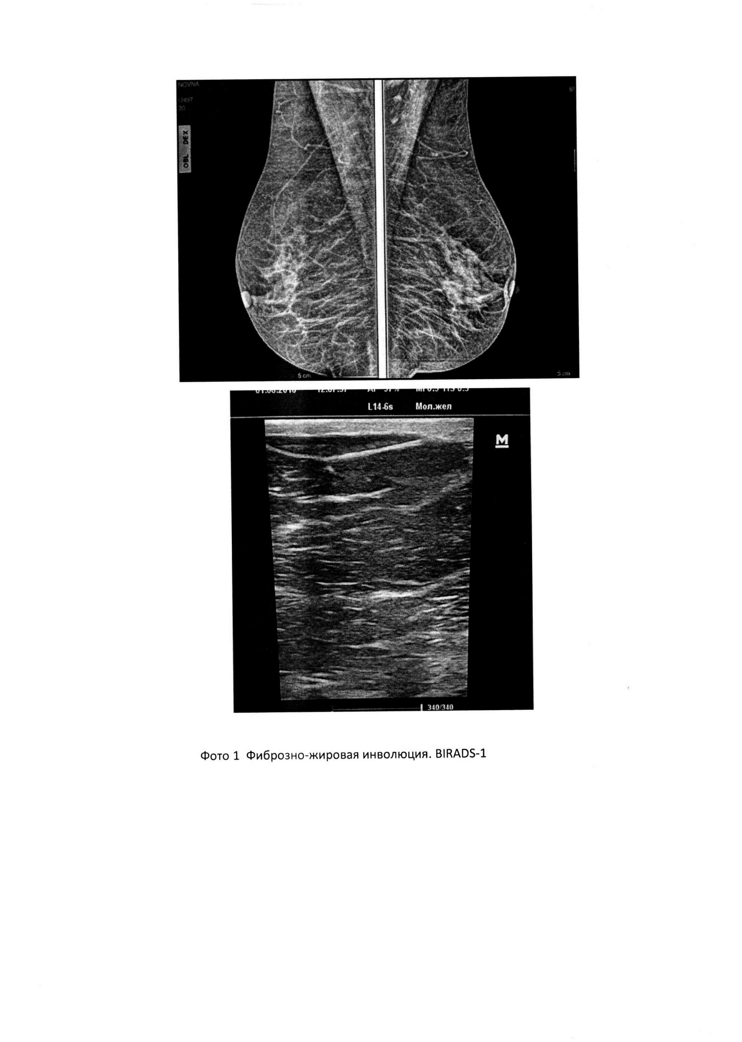 Что такое фиброзно жировая инволюция. Фиброзно жировая инволюция на УЗИ. Маммография жировая инволюция. Фиброзно-жировая инволюция молочных желез маммография. Инволюция молочных желез УЗИ.