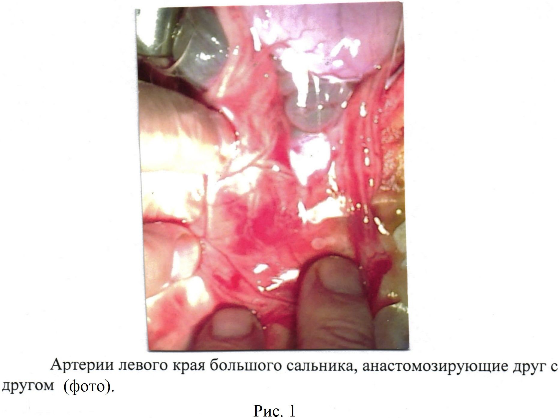 Способ хирургического лечения цирроза печени в эксперименте