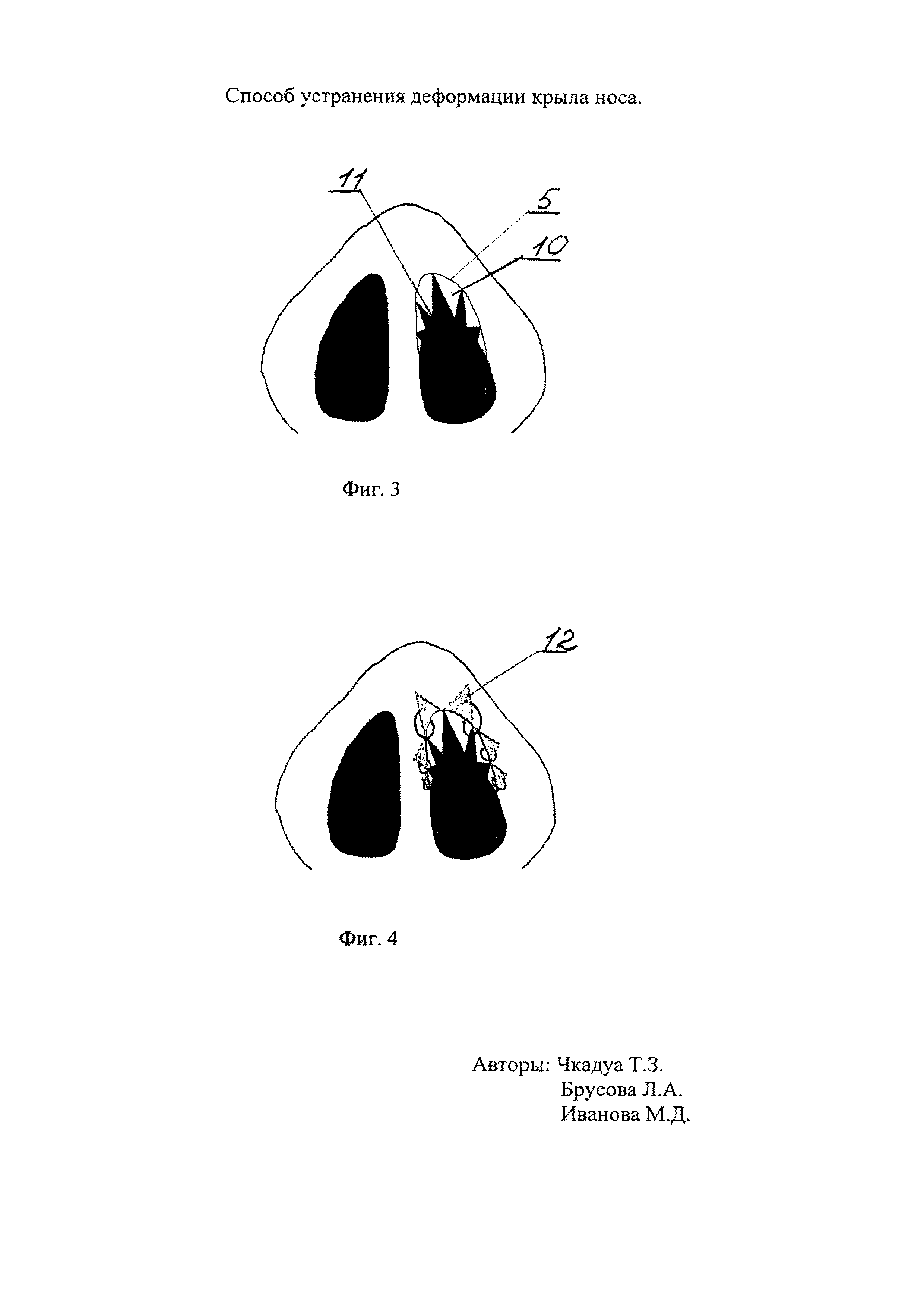 Способ устранения деформации крыла носа