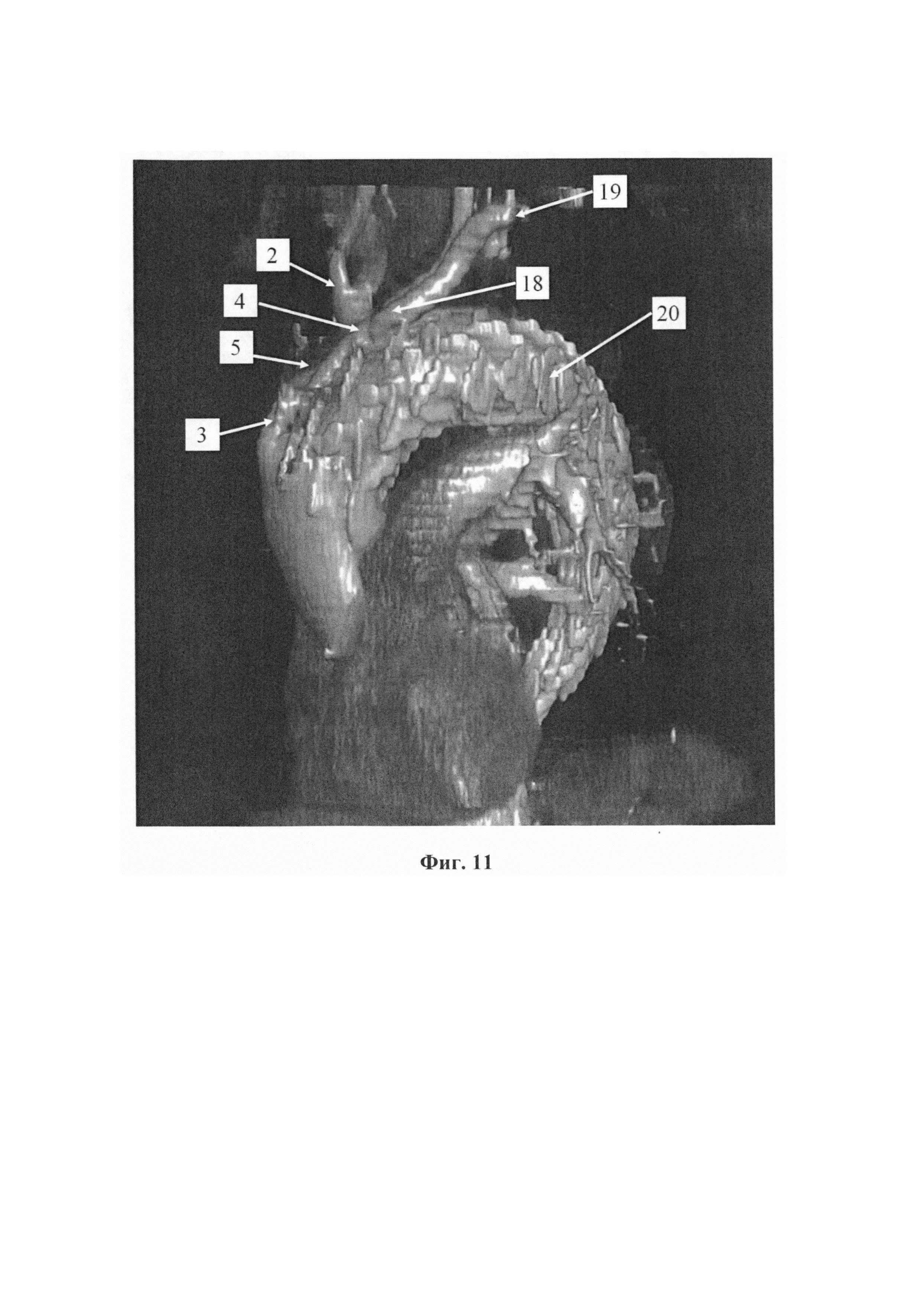 Способ гибридного лечения аневризмы аорты без искусственного кровообращения с поддержанием перфузии головного мозга во время транспозиции ветвей дуги аорты