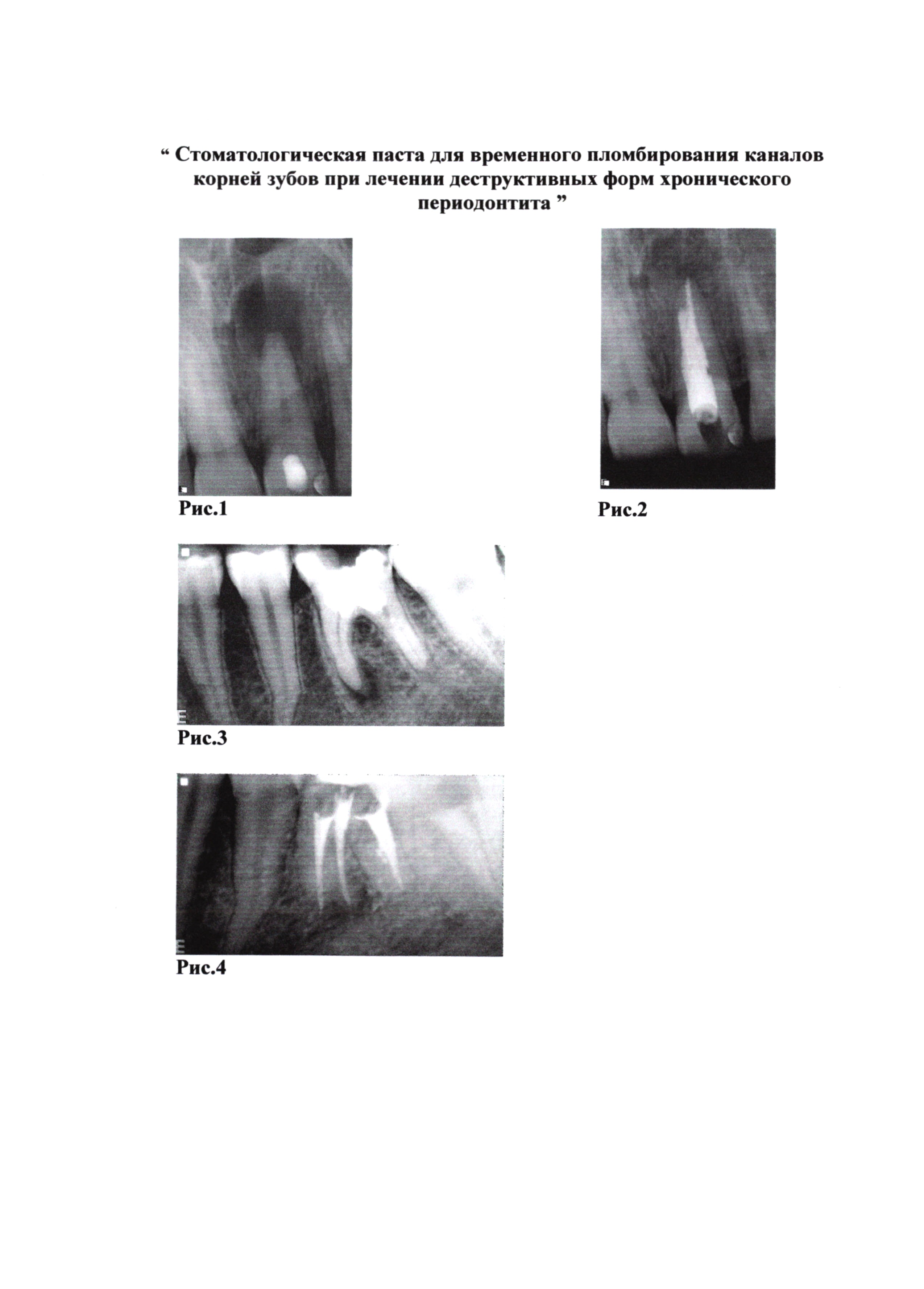 Стоматологическая паста для временного пломбирования каналов корней зубов при лечении деструктивных форм хронического периодонтита