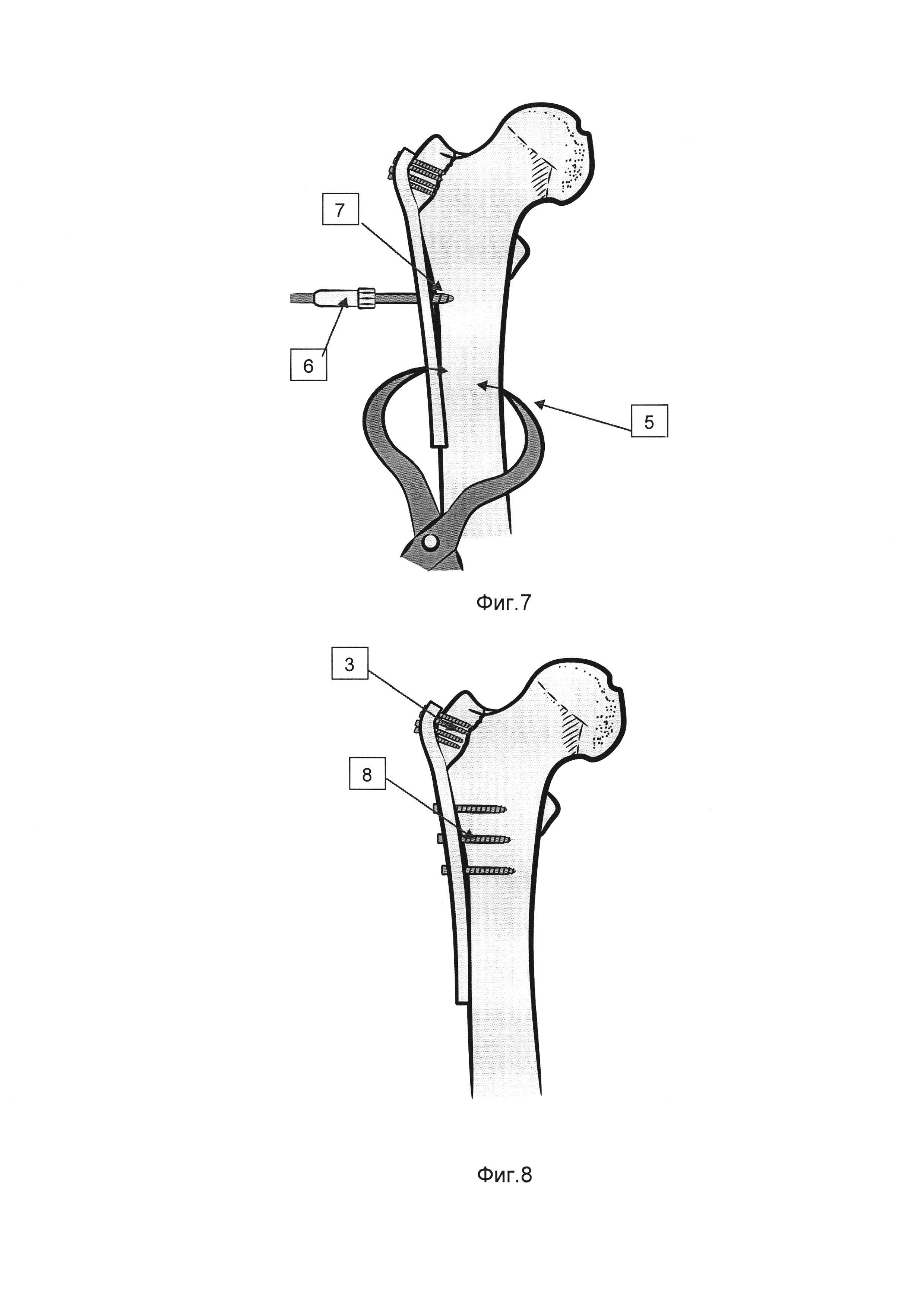 Способ хирургического лечения оскольчатого перелома большого вертела
