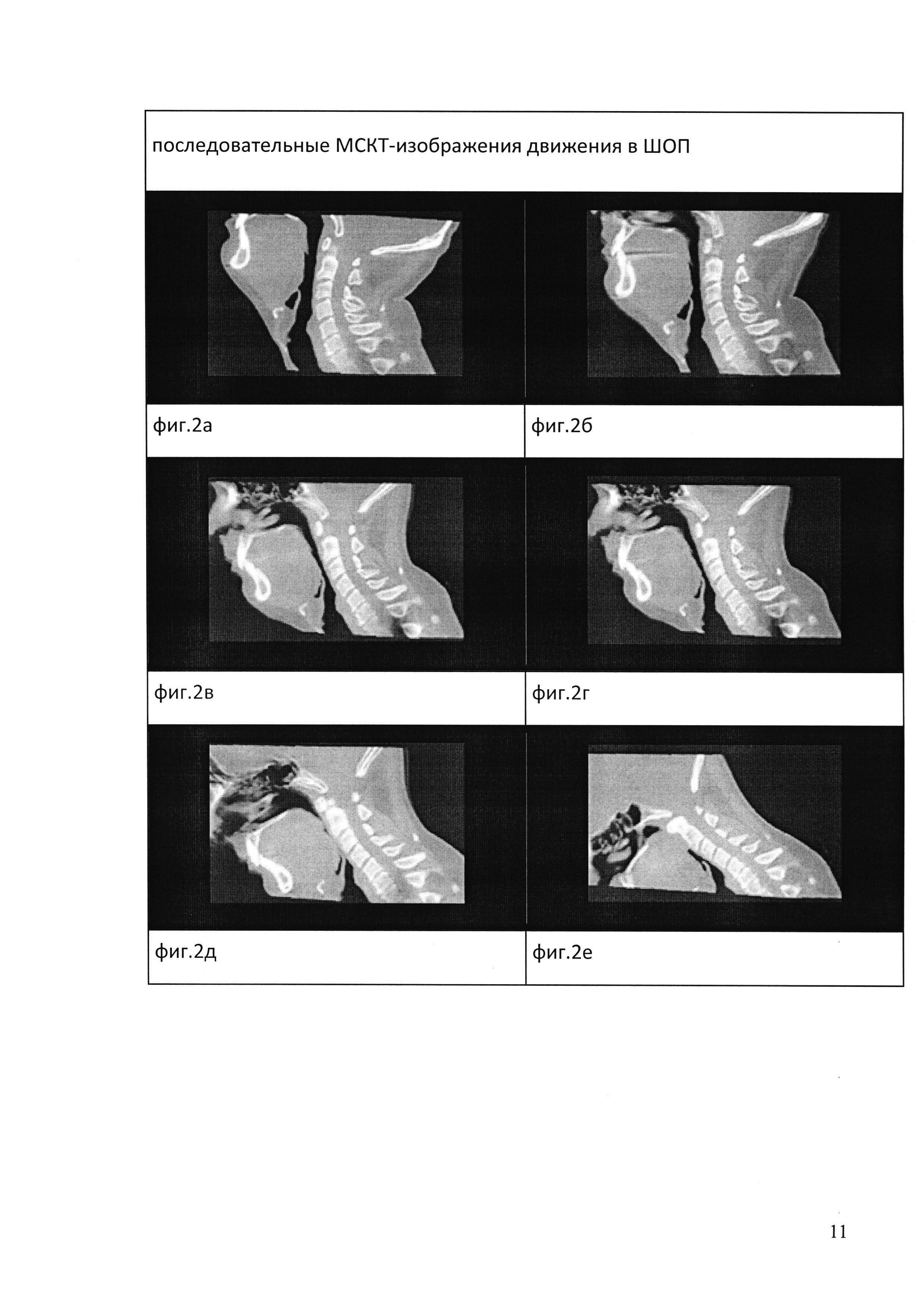 Способ функциональной мультиспиральной компьютерно-томографической диагностики нестабильности позвоночно-двигательных сегментов шейного отдела позвоночника