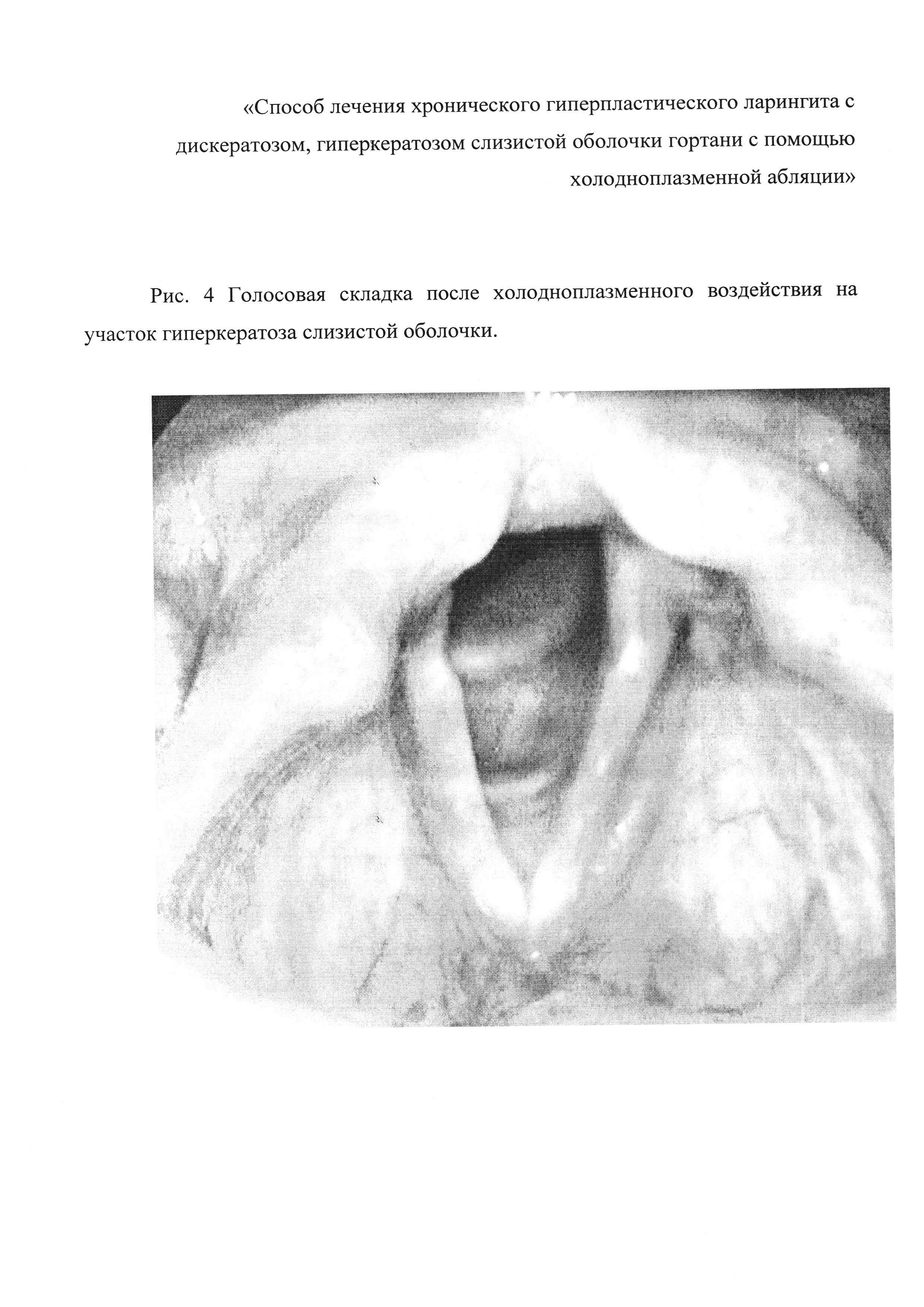 Способ лечения хронического гиперпластического ларингита с дискератозом, гиперкератозом слизистой оболочки гортани с помощью холодноплазменной абляции