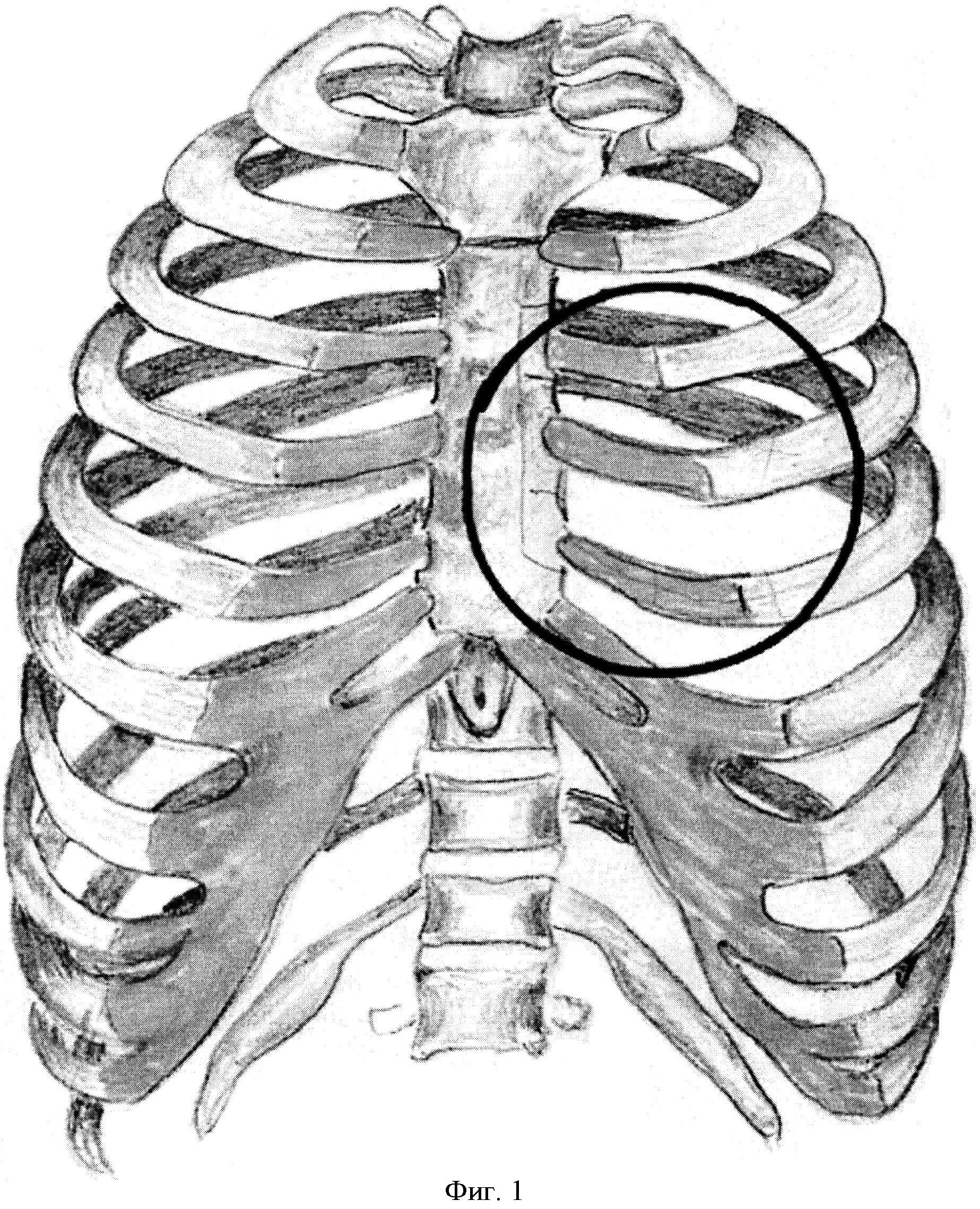 Повреждение легкого ребрами. Вывих ребра грудной клетки рентген. Переломы 9 10 ребра грудной клетки.