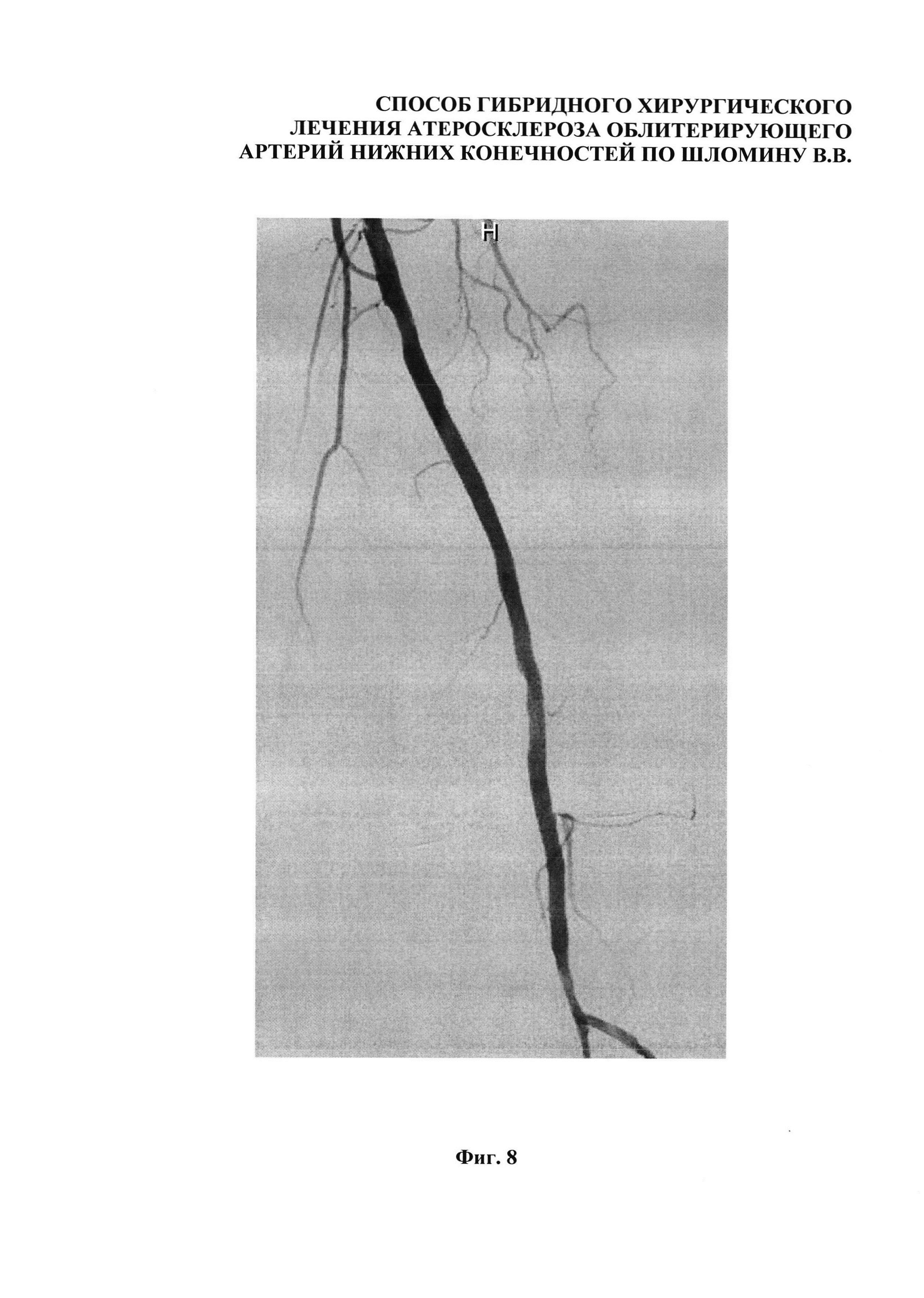 Способ гибридного хирургического лечения облитерирующего атеросклероза артерий нижних конечностей