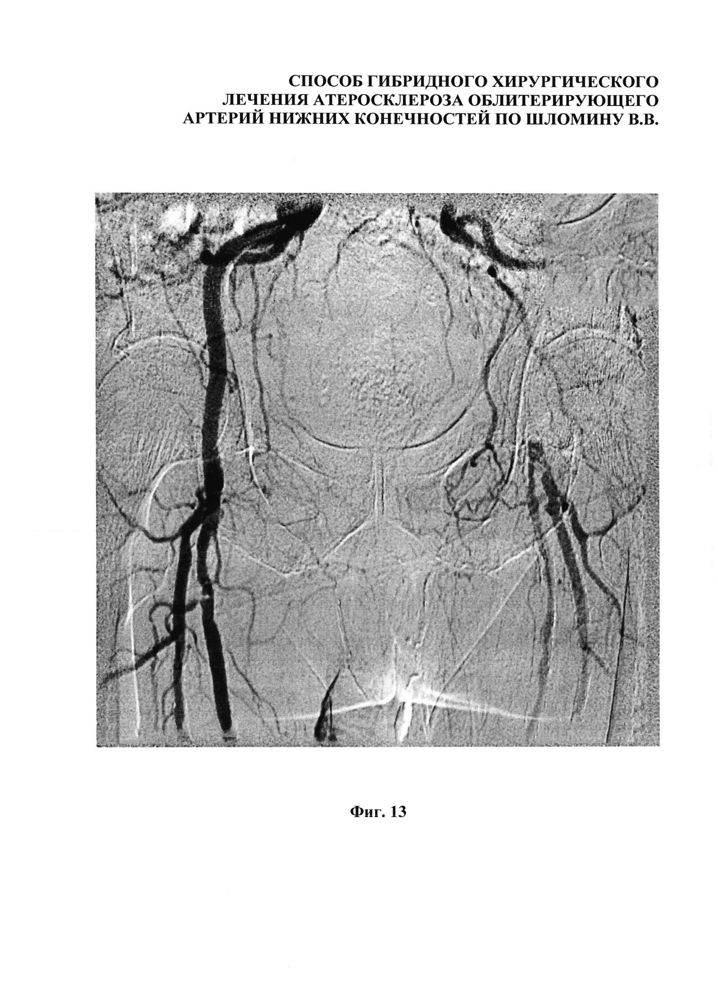 Способ гибридного хирургического лечения облитерирующего атеросклероза артерий нижних конечностей