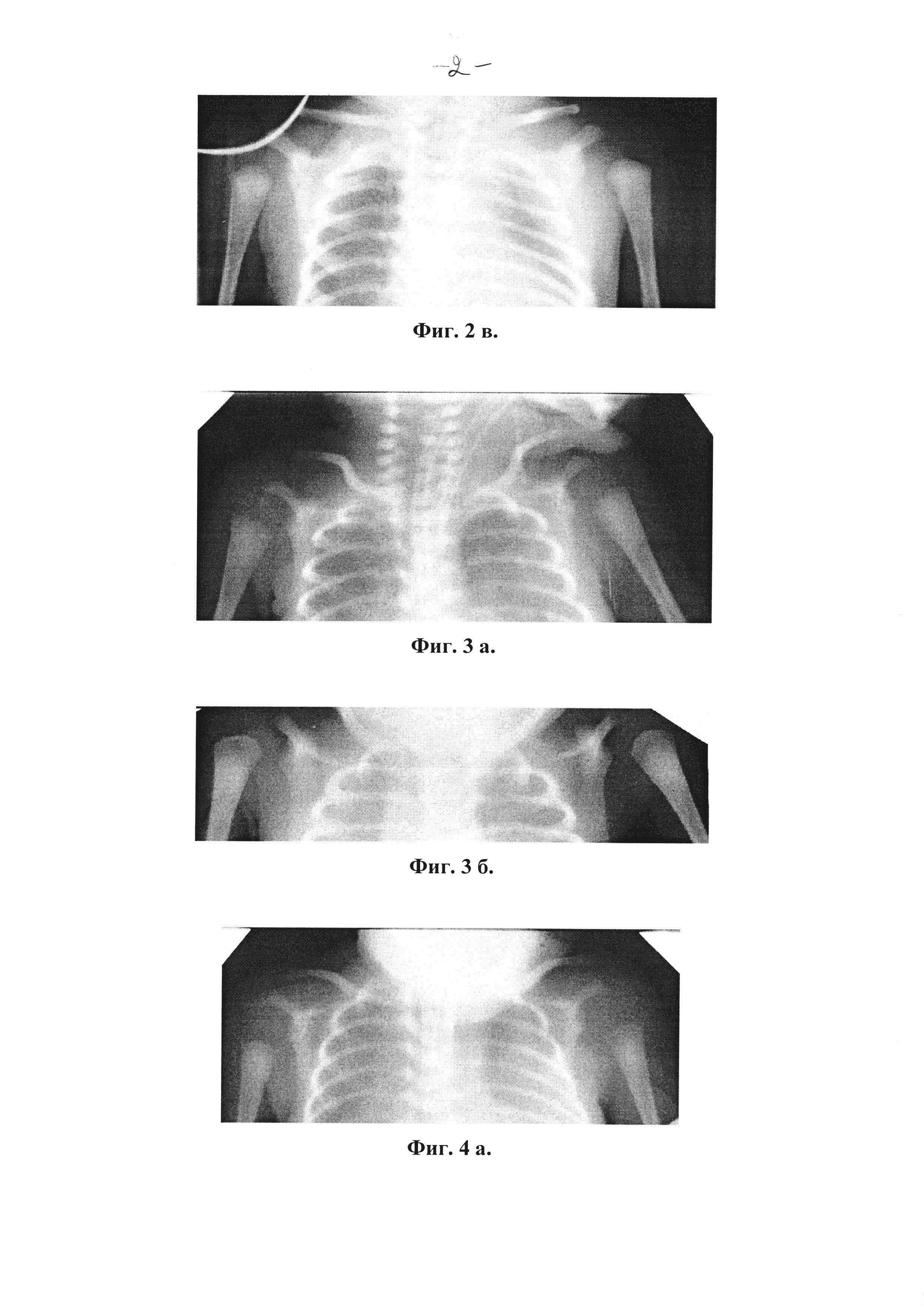 Способ рентгенологической диагностики остеопении (метаболической болезни костей) и раннего рахита у недоношенных детей