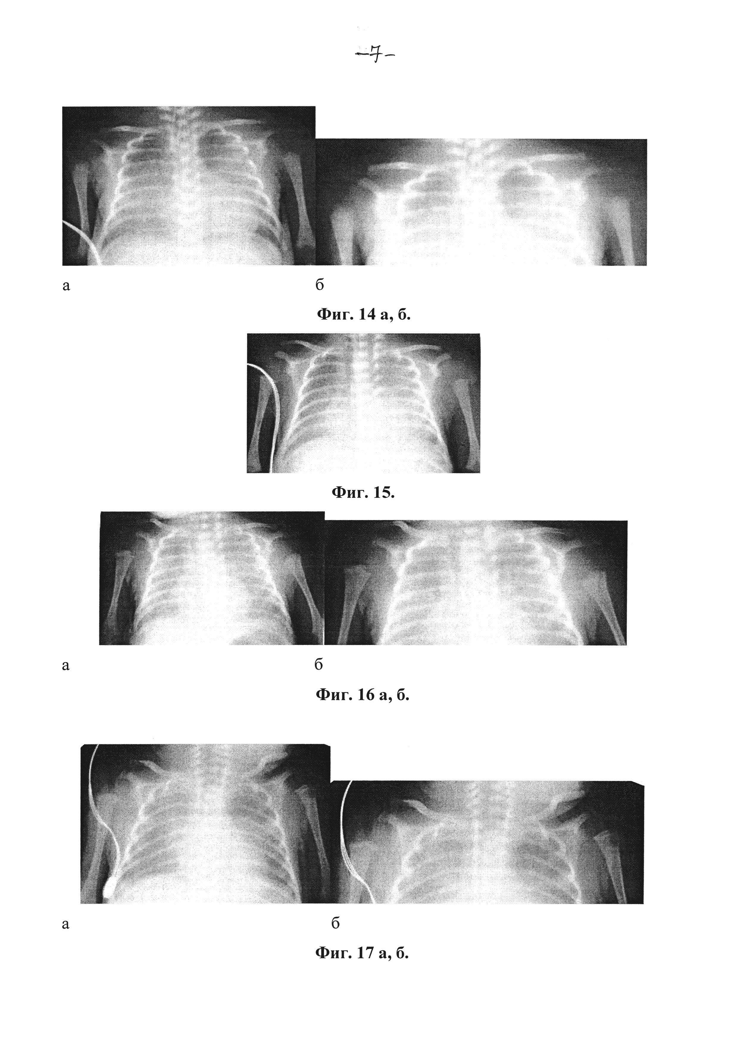 Способ рентгенологической диагностики остеопении (метаболической болезни костей) и раннего рахита у недоношенных детей
