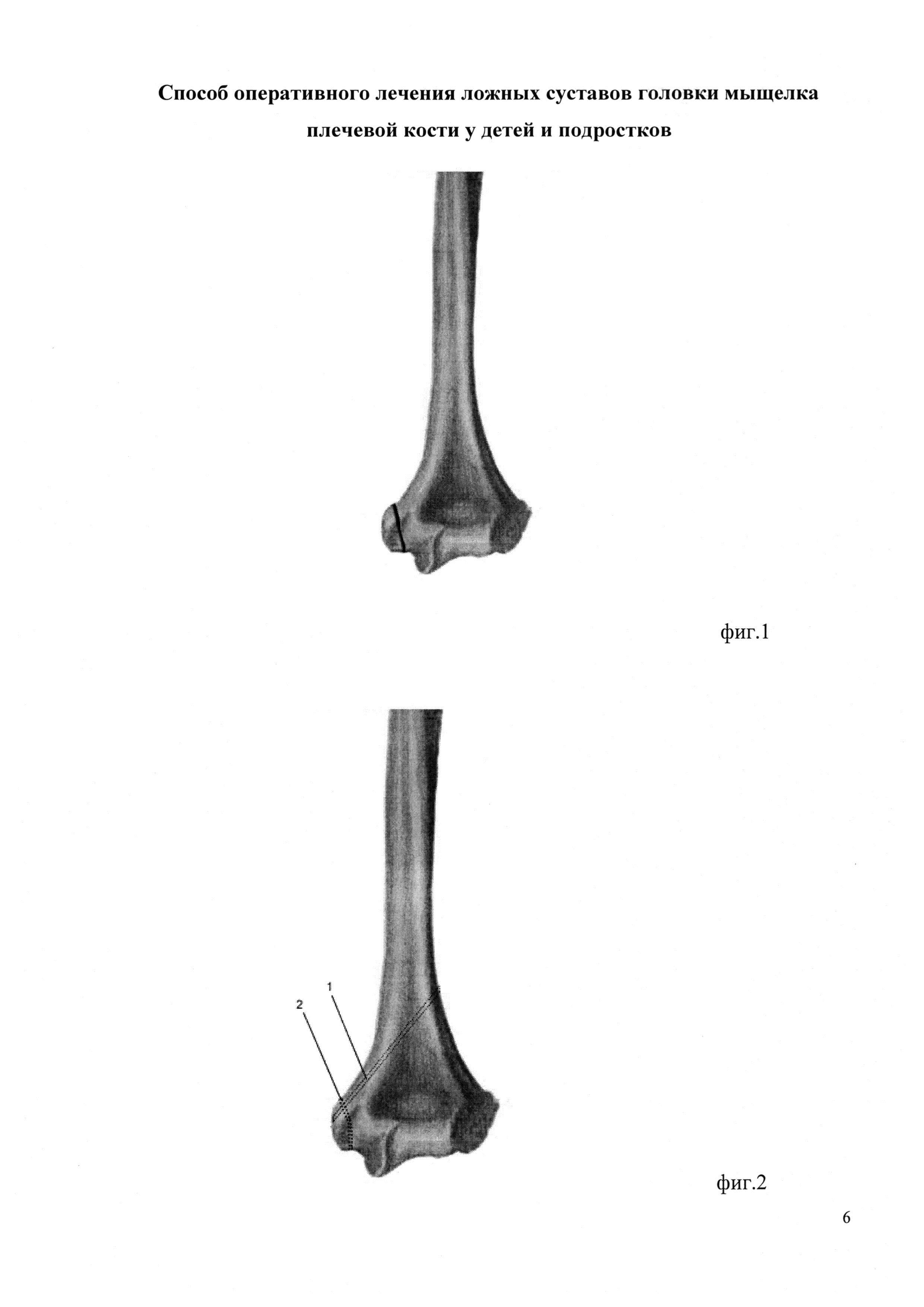 Мыщелок это кость. Перелом мыщелка плечевой кости. Головка мыщелка плечевой кости. Плечевая кость мыщелок плечевой кости. Мышеора плечевой кости.