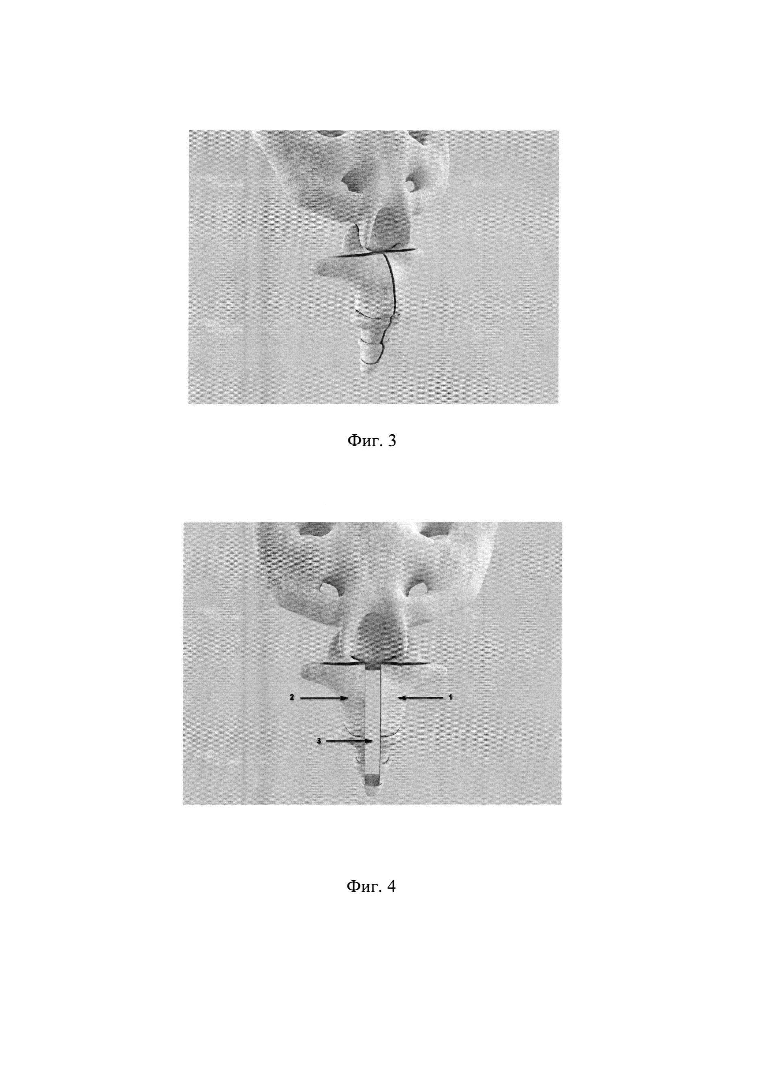 Способ оперативного лечения посттравматической кокцигодинии с использованием аллопланта седалищного нерва и перфорированной металлической пластины для замещения костного дефекта