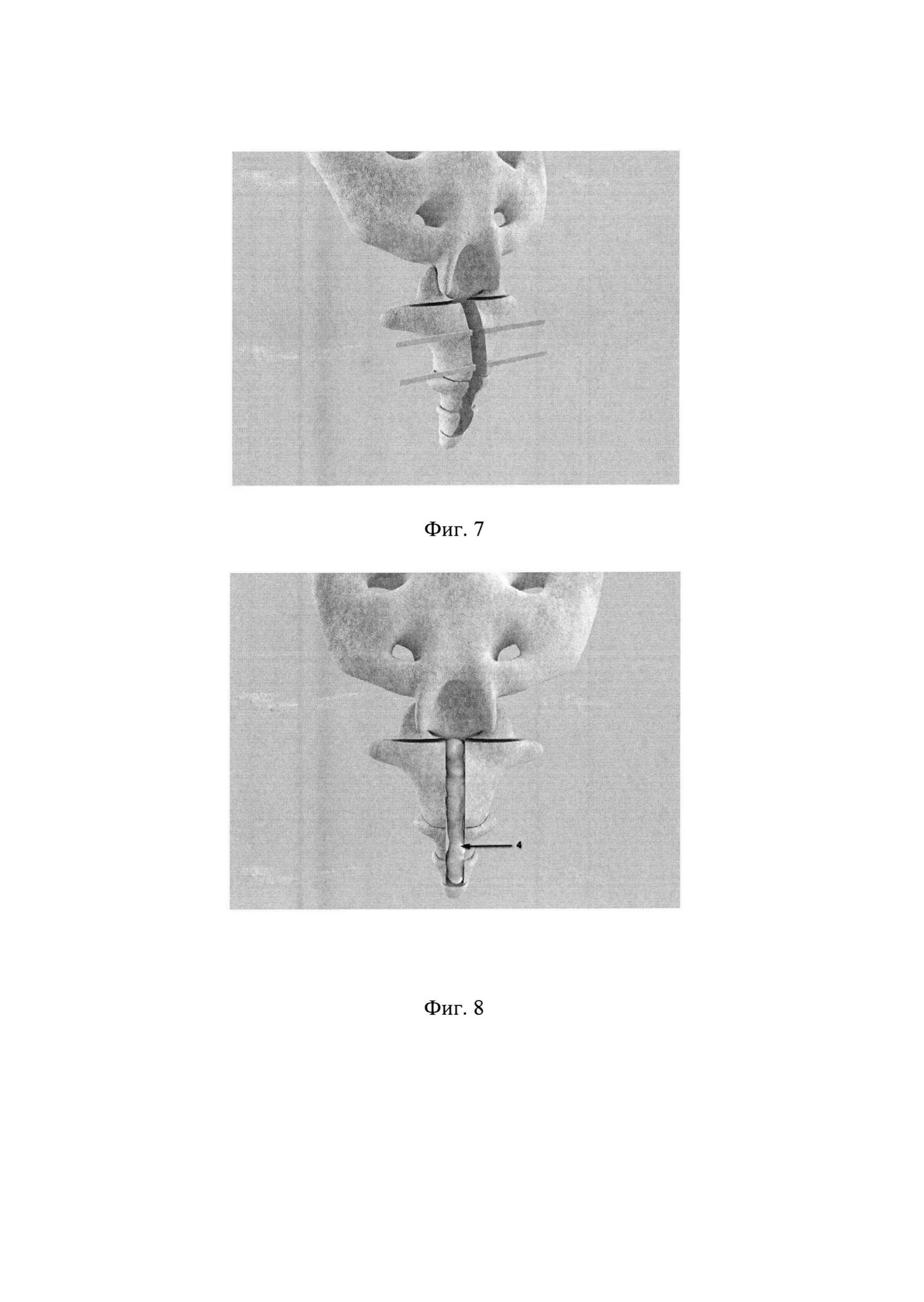 Способ оперативного лечения посттравматической кокцигодинии с использованием аллопланта седалищного нерва и перфорированной металлической пластины для замещения костного дефекта