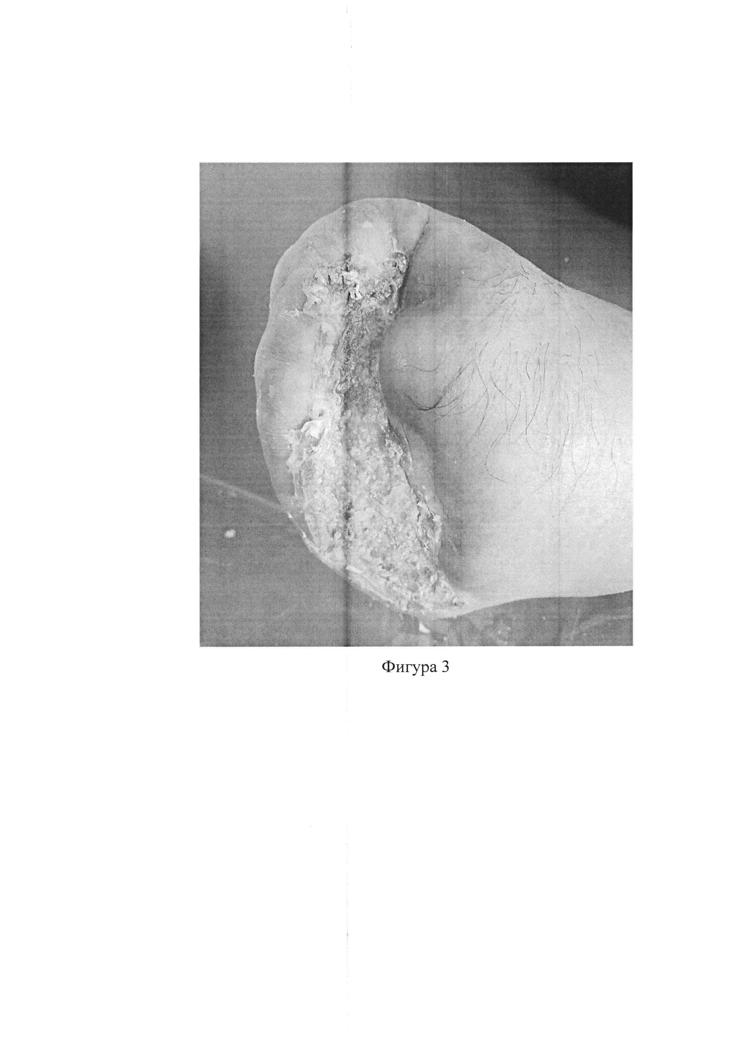 Способ лечения ран кожи и мягких тканей с помощью раневого покрытия на основе бактериальной целлюлозы